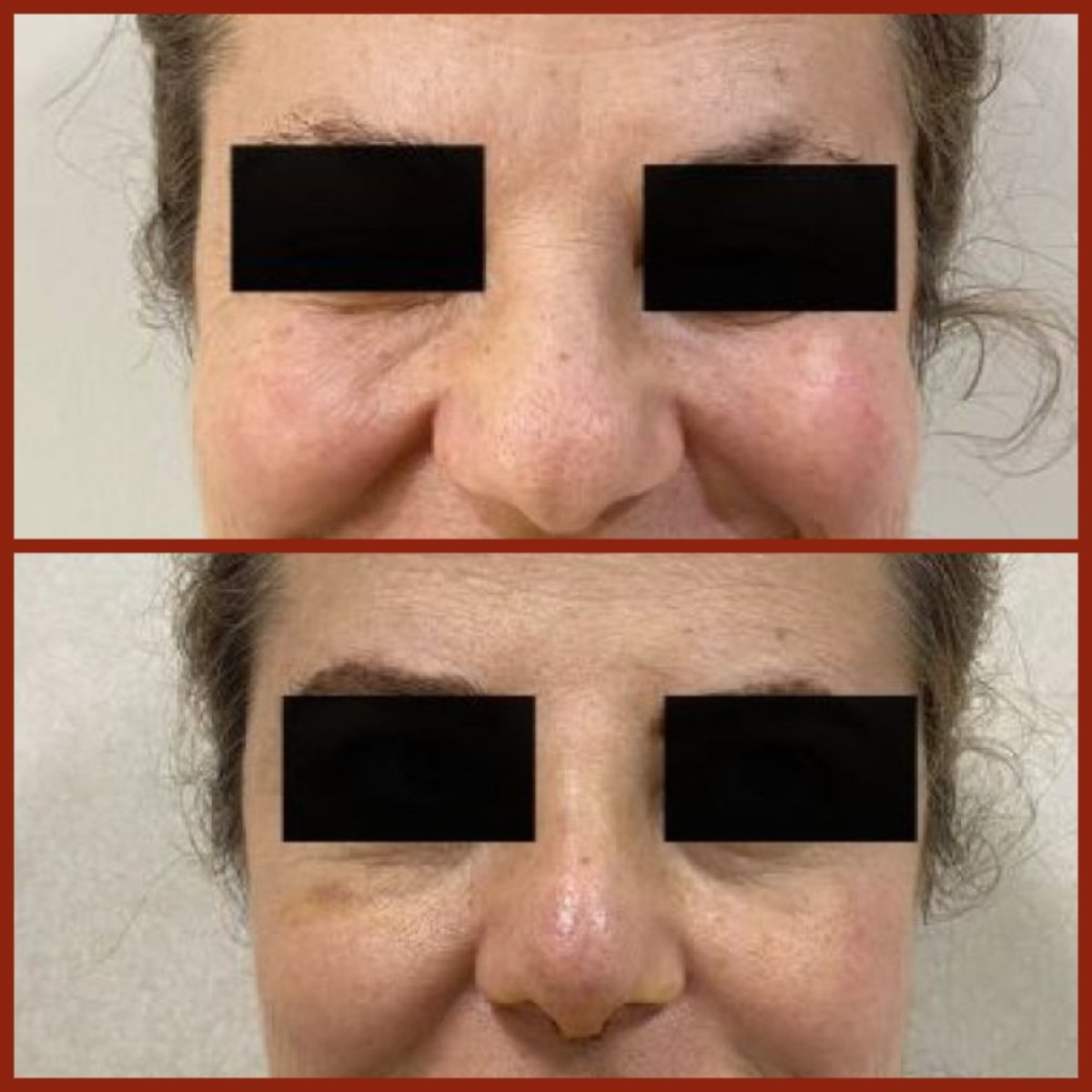 Antes y después de rinoplastia en DGB Clinic, remodelación nasal con mejor contorno