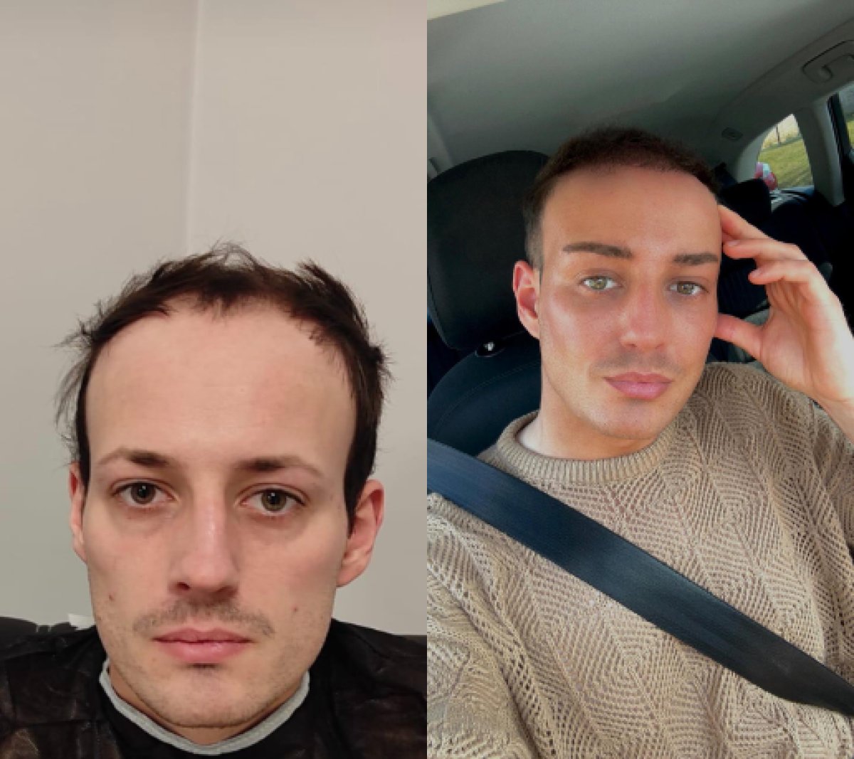 Forehead lift before and after results at Istanbul Aesthetic Plastic Surgery Center, rejuvenation