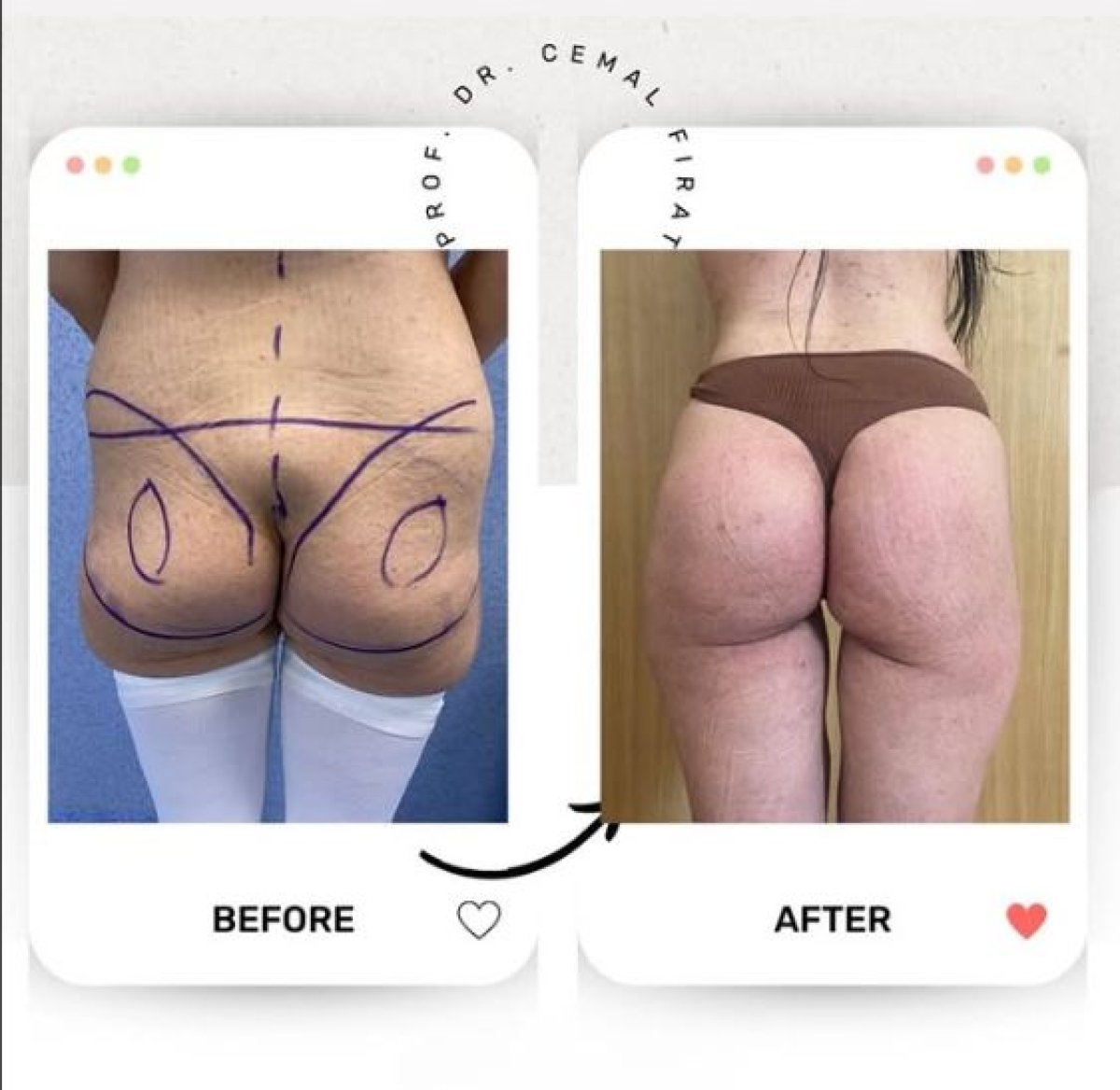 Результаты до и после Brazilian Butt Lift в Medical Park Antalya Hospital Complex