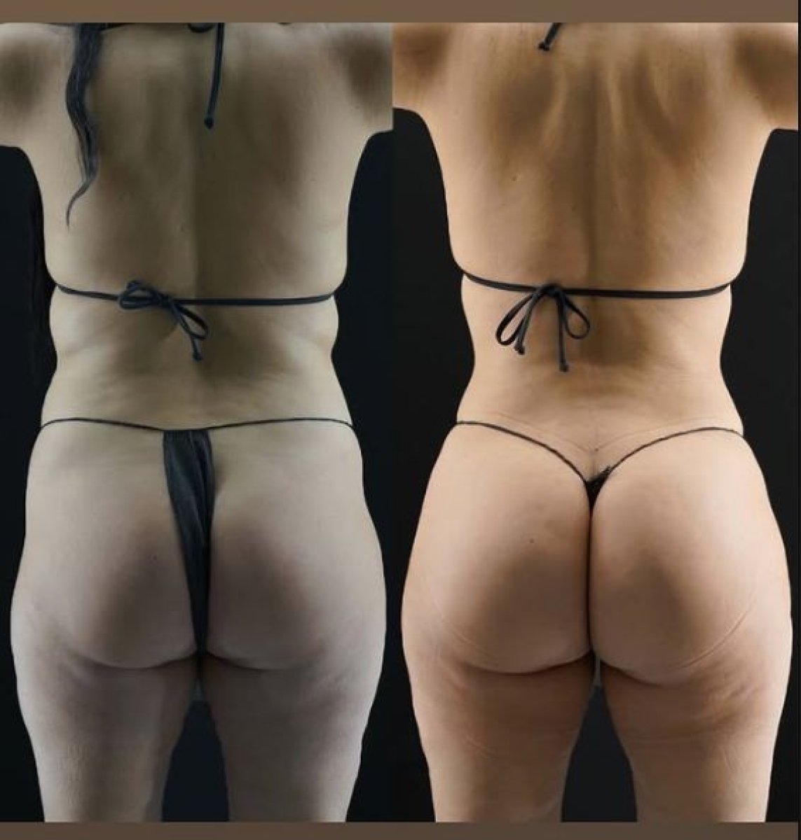 Результаты до и после Brazilian Butt Lift в Medical Park Antalya Hospital Complex