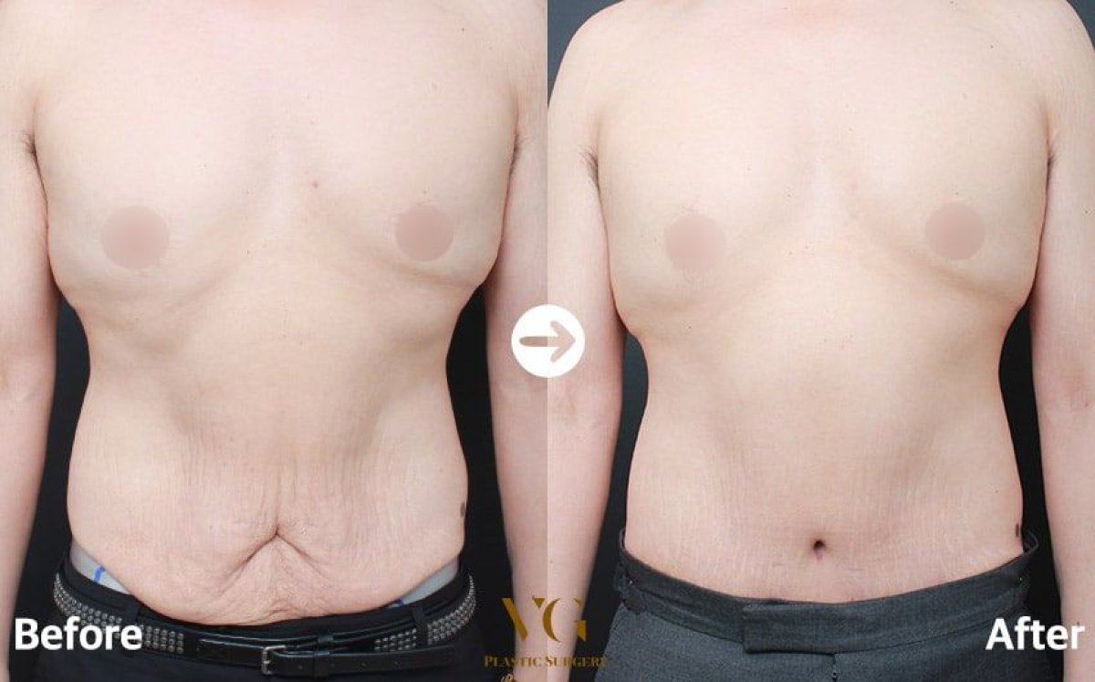 نتائج شفط الدهون قبل وبعد في VG Plastic Surgery، تحسين شكل البطن لدى رجل