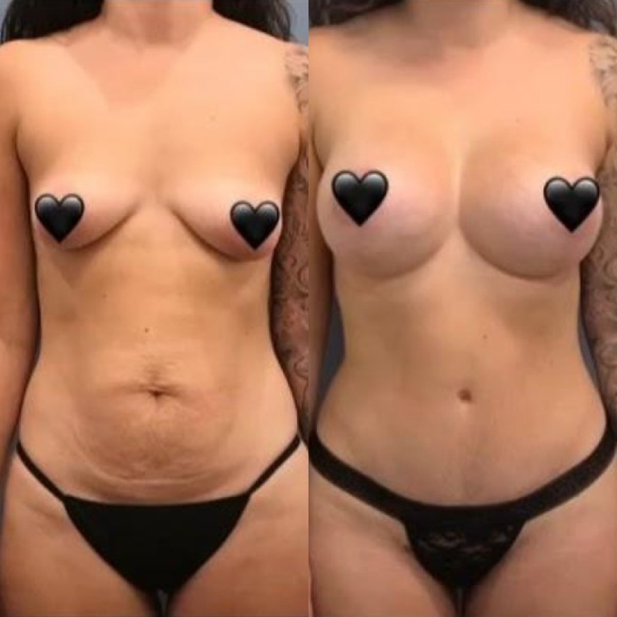 Before and after breast augmentation results at Istanbul Aesthetic Plastic Surgery Center
