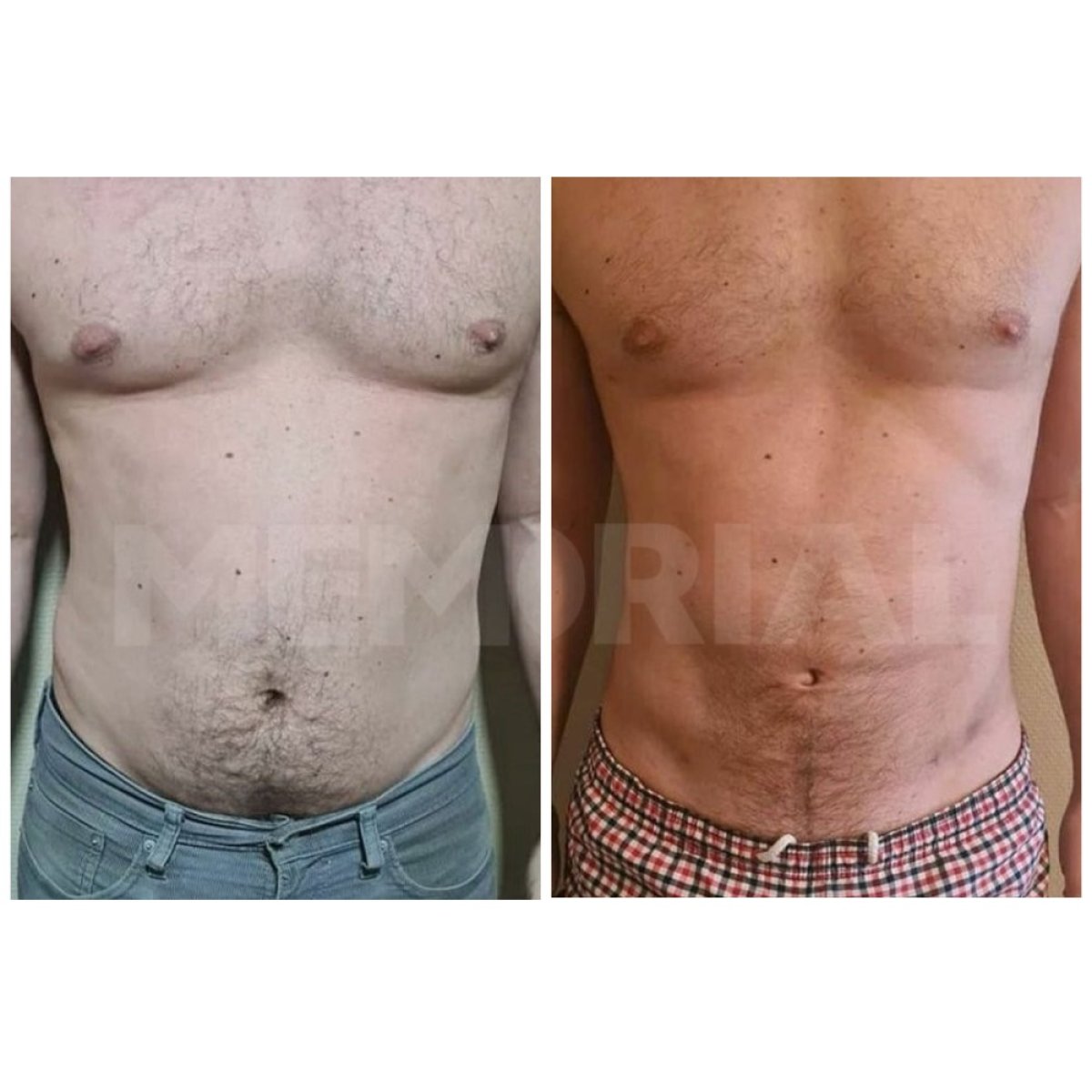 Resultados antes y después de marcación abdominal en Memorial Bahçelievler Hospital, abdominales