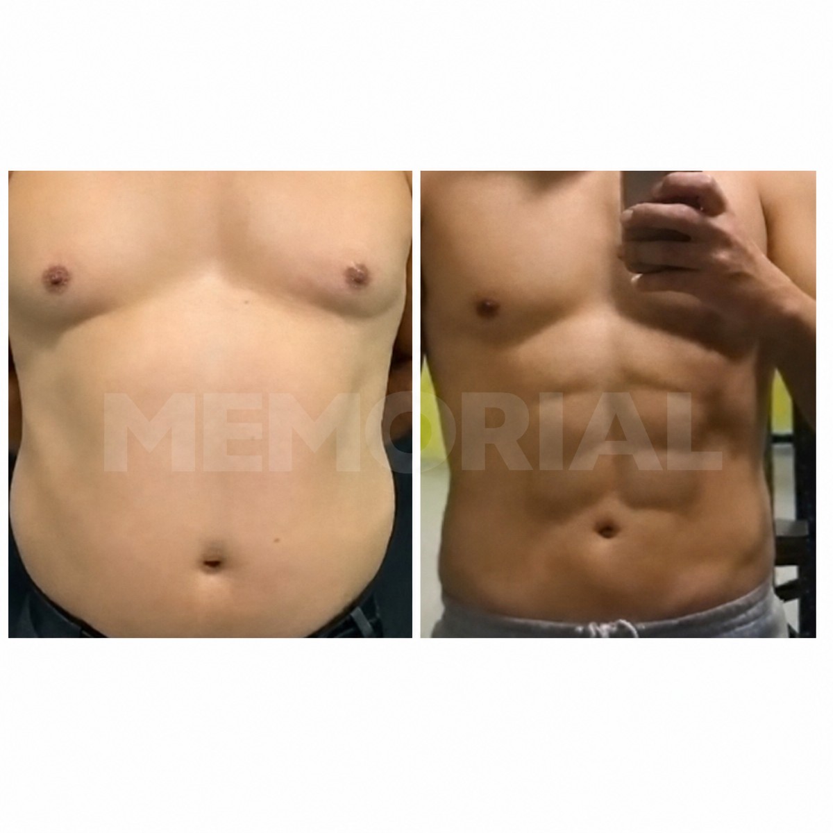 Resultados antes y después de marcación abdominal en Memorial Bahçelievler Hospital, abdominales