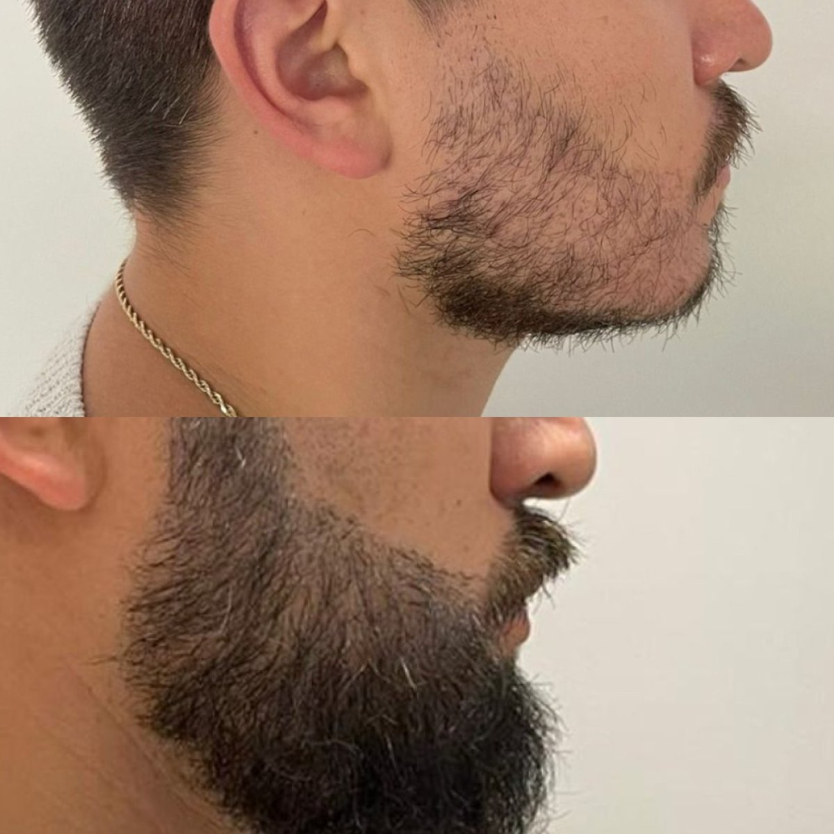 Résultat avant-après greffe de barbe chez Hair In 1 Day Mexico City, barbe plus dense
