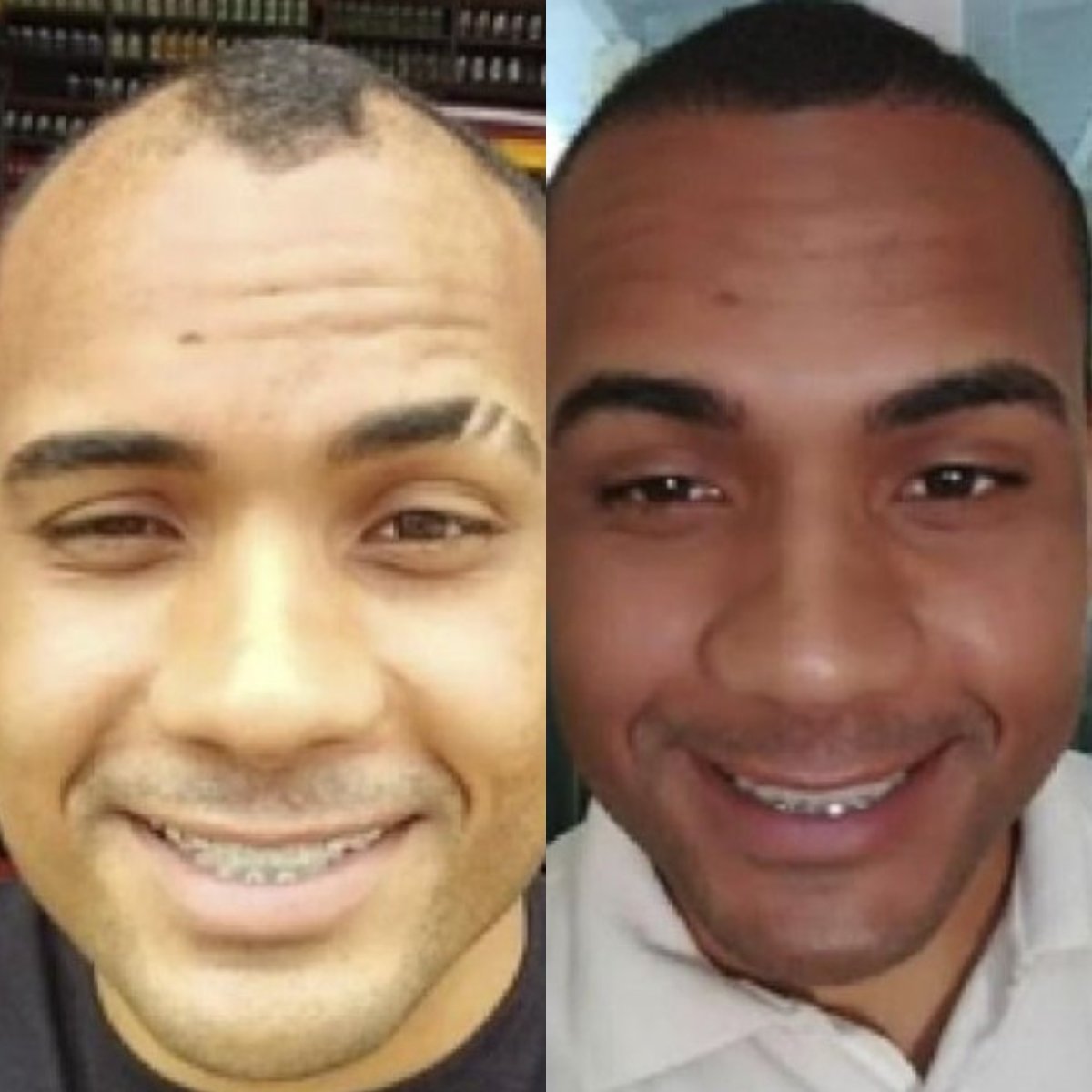 Resultados antes y después de trasplante de cejas en Hair In 1 Day Monterrey, cejas más densas