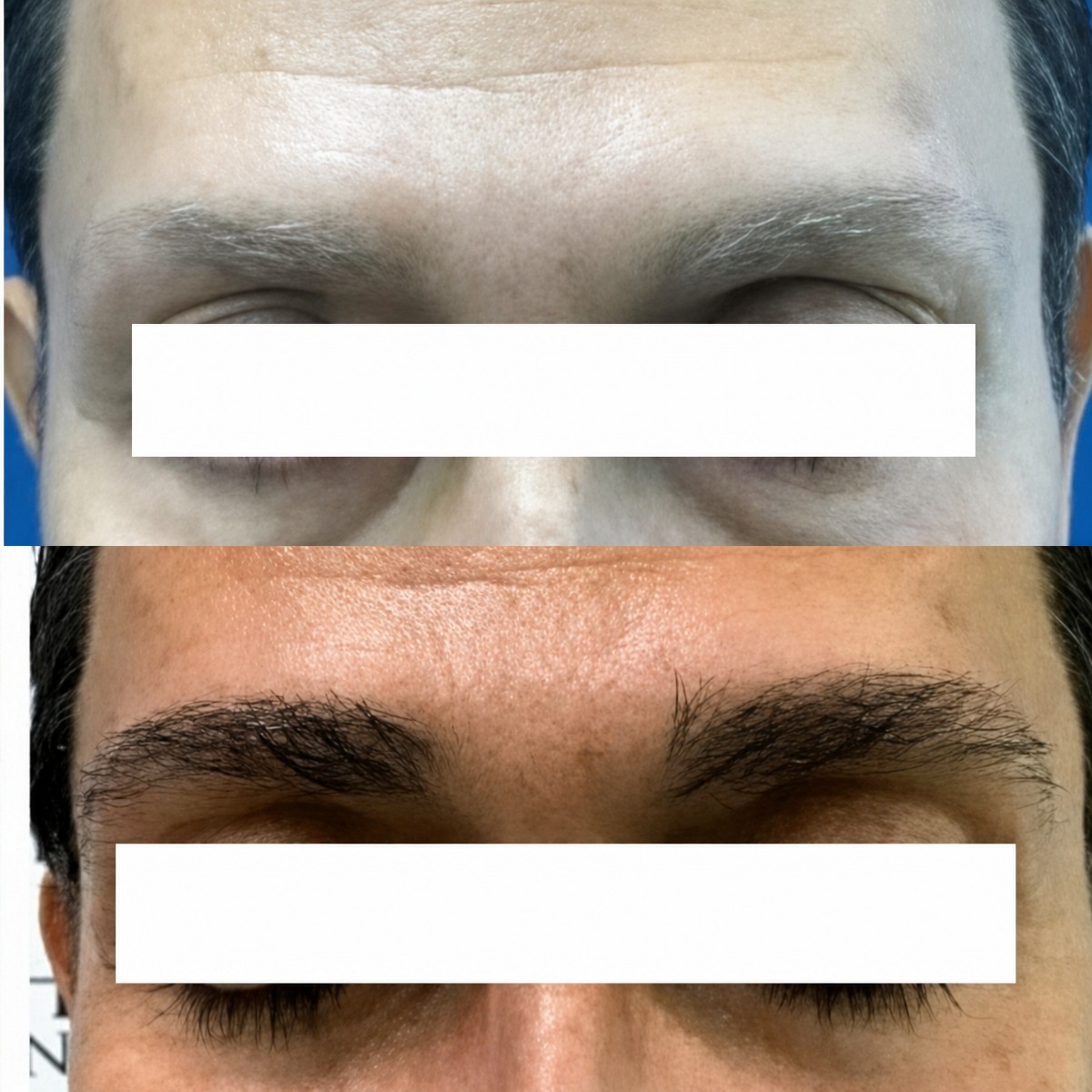 Resultados de trasplante de cejas antes y después en Hair In 1 Day Monterrey, cejas más densas