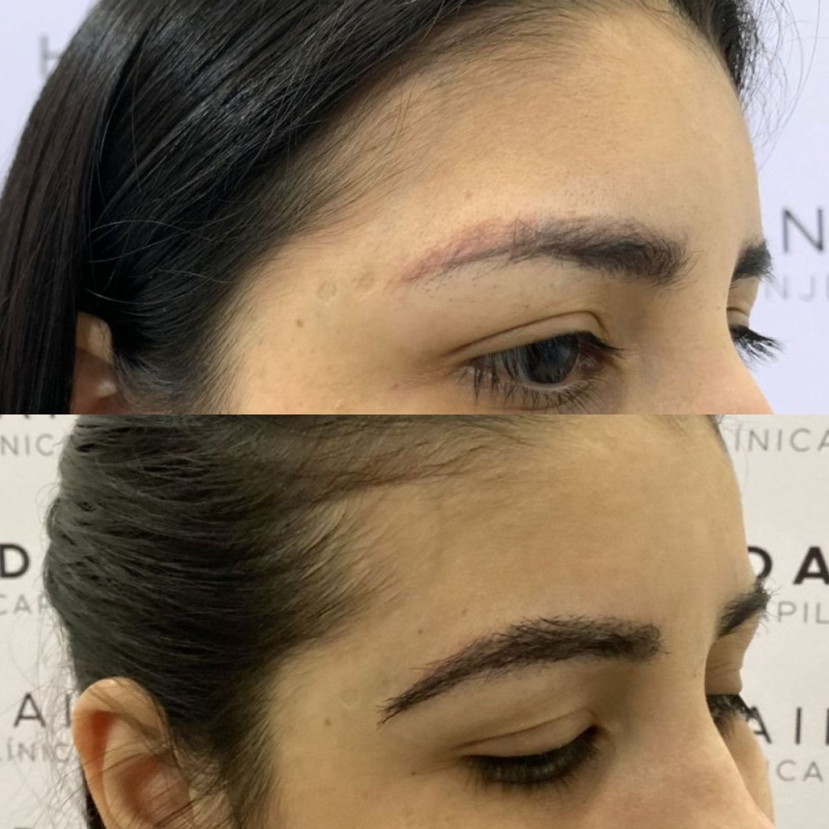 Vorher-nachher-Ergebnis Augenbrauentransplantation bei Hair In 1 Day Monterrey, dichtere Brauen