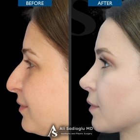 Premium Rhinoplasty (nose job) All Included - photo 5