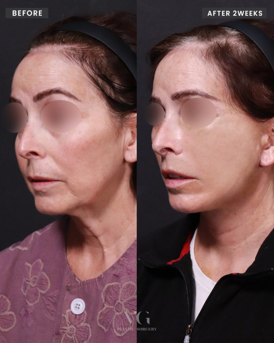 Resultados de lifting facial antes y después en VG Plastic Surgery – rejuvenecimiento facial en 2 semanas