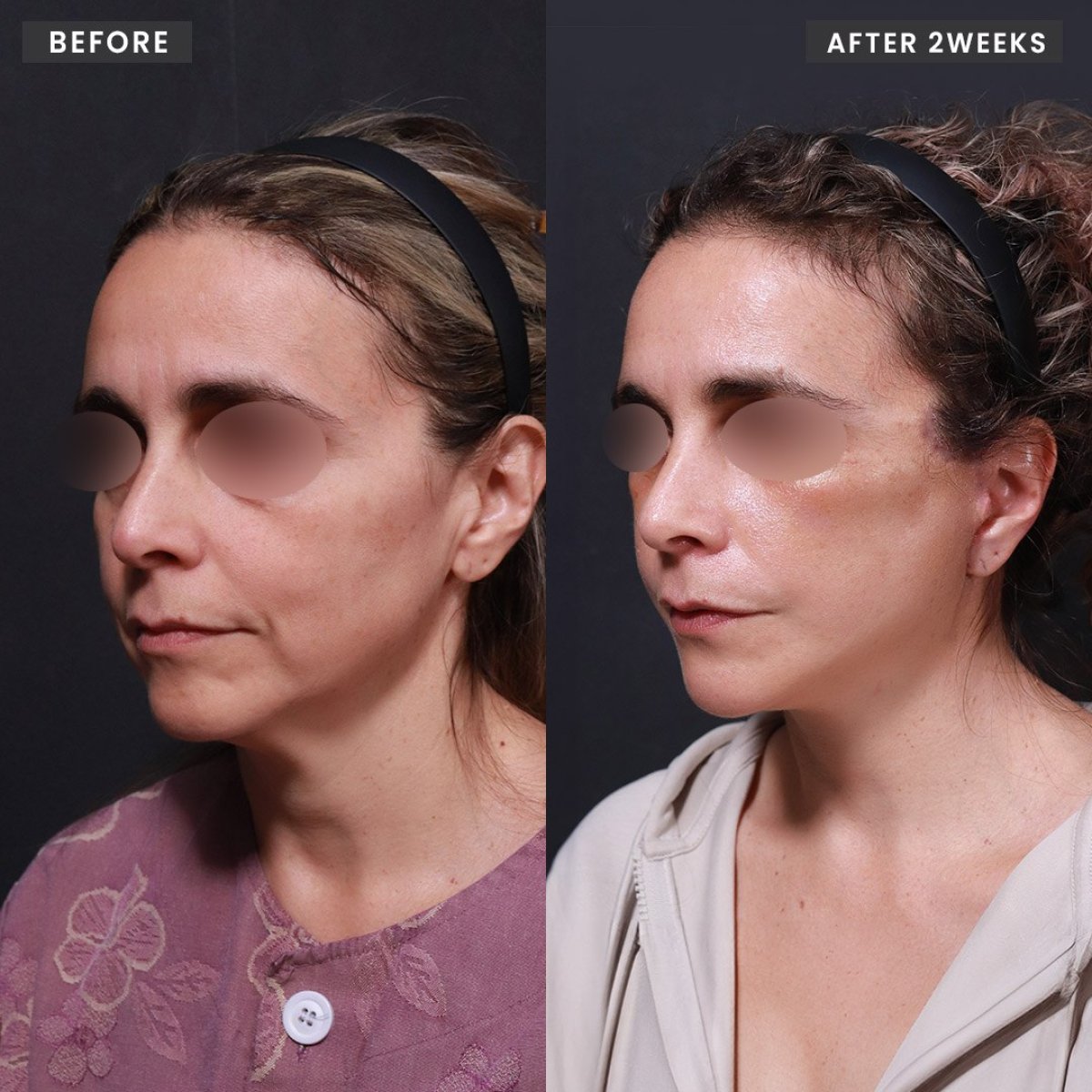 نتائج شد الوجه قبل وبعد في VG Plastic Surgery، تجديد شباب الوجه بعد أسبوعين