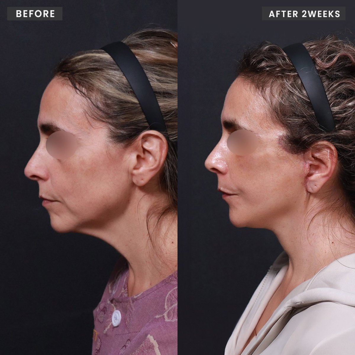 Resultados de lifting facial antes y después en VG Plastic Surgery, mejora del contorno facial