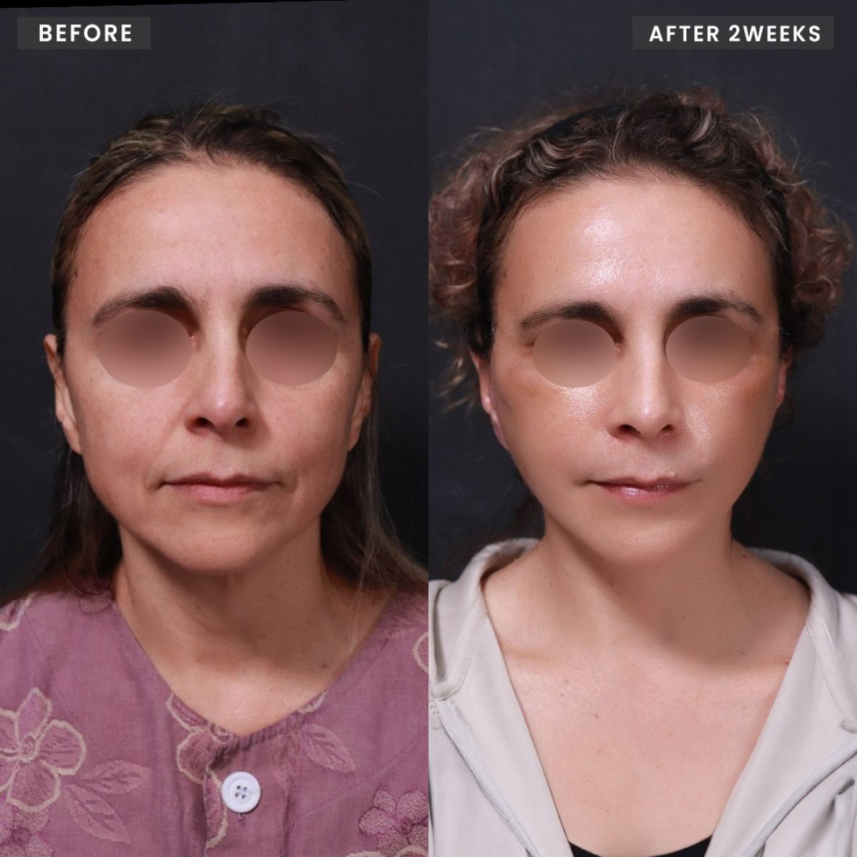 نتائج شد الوجه قبل وبعد في VG Plastic Surgery، تجديد شباب الوجه بعد أسبوعين