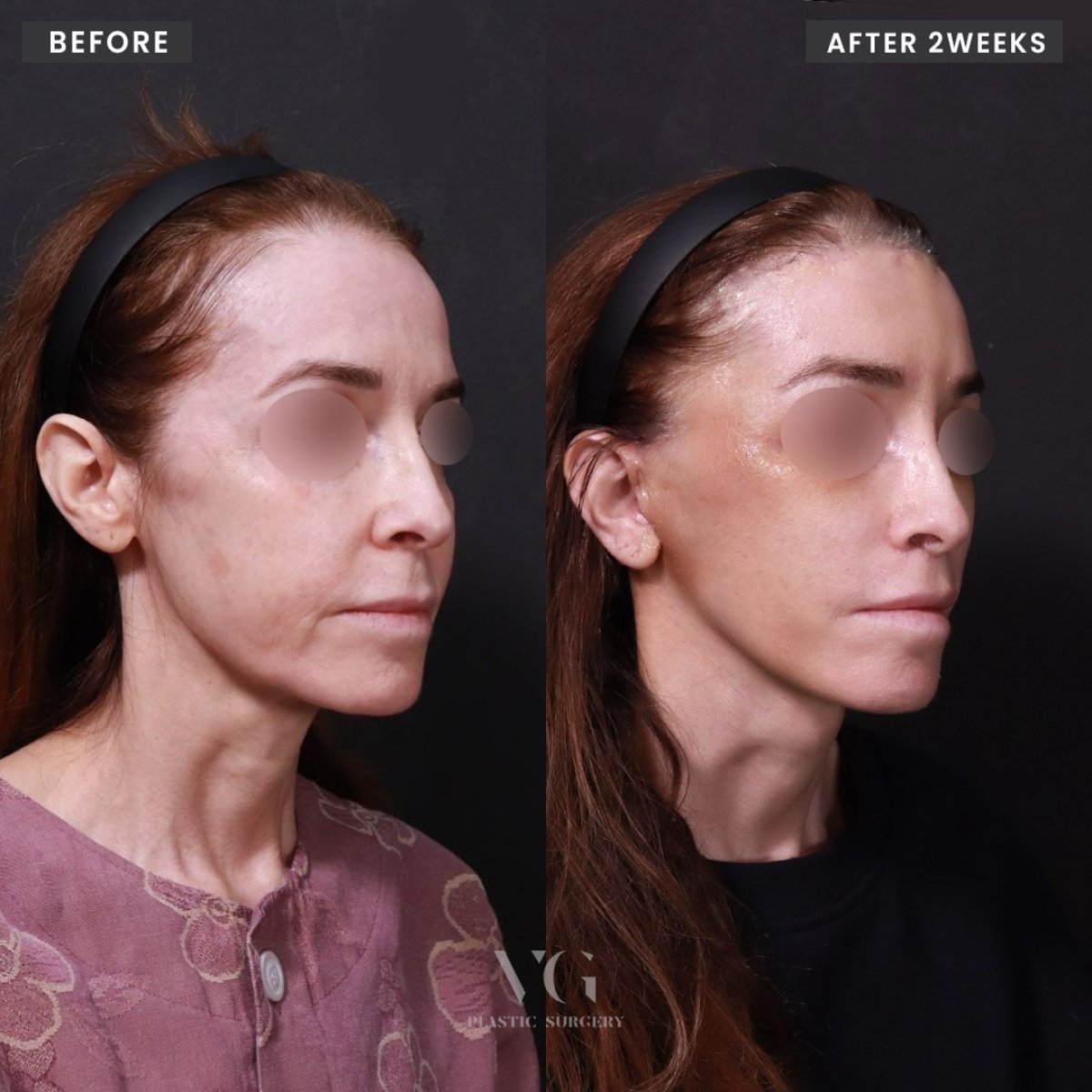 Resultados de lifting facial antes y después en VG Plastic Surgery, rejuvenecimiento facial tras 2 semanas