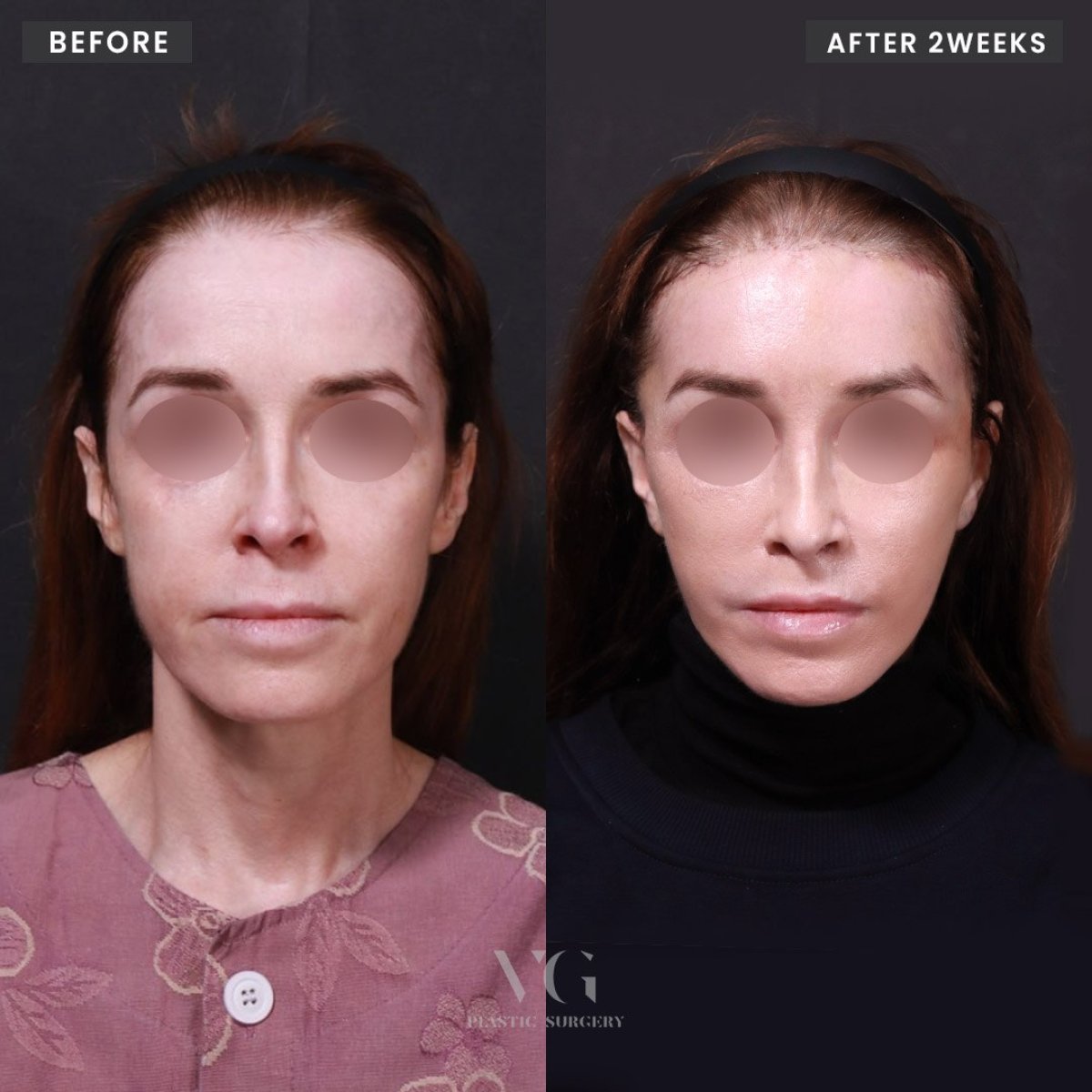 نتائج شد الوجه قبل وبعد في VG Plastic Surgery – تجديد واضح للوجه بعد أسبوعين
