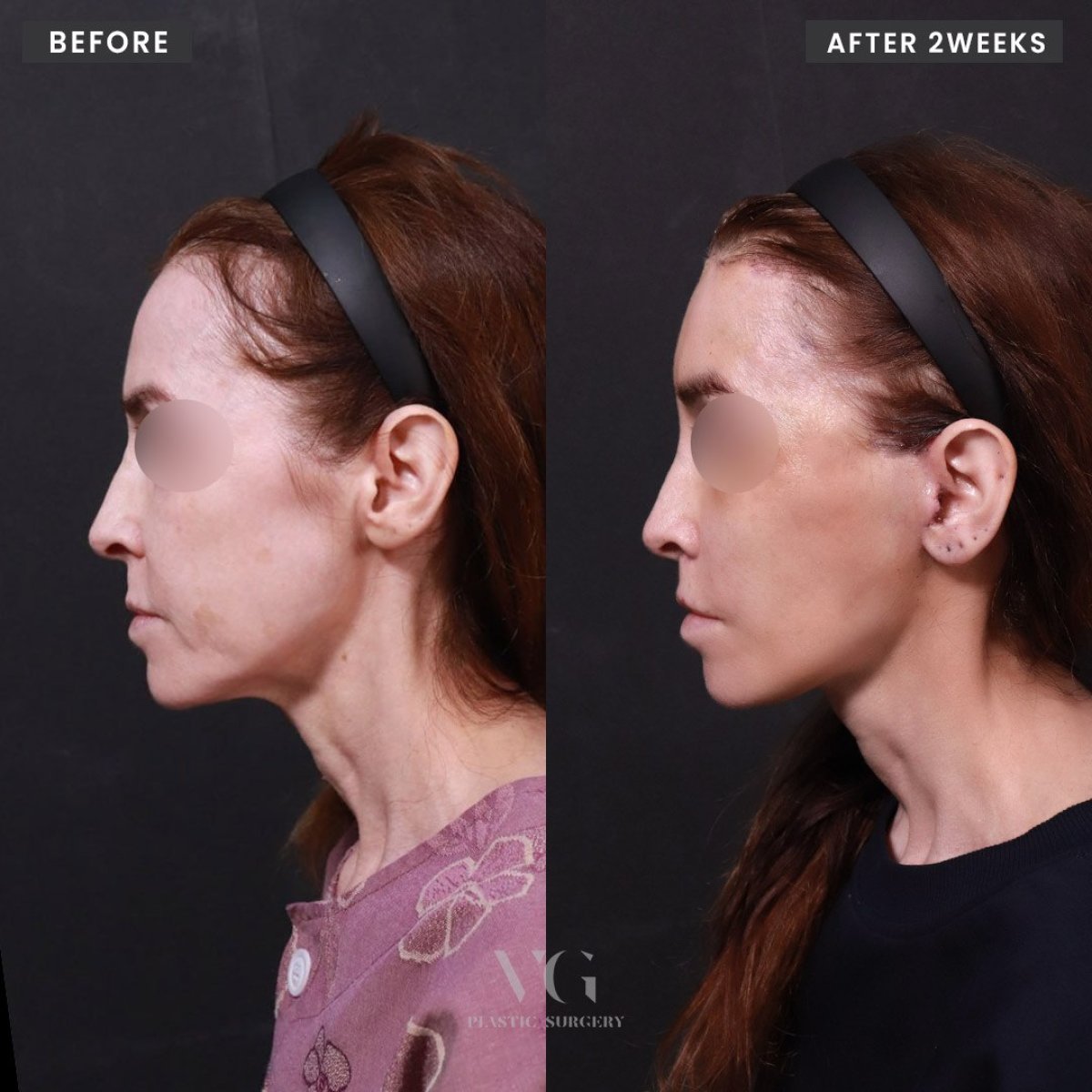 Resultados de lifting facial antes y después en VG Plastic Surgery, mejora del contorno facial