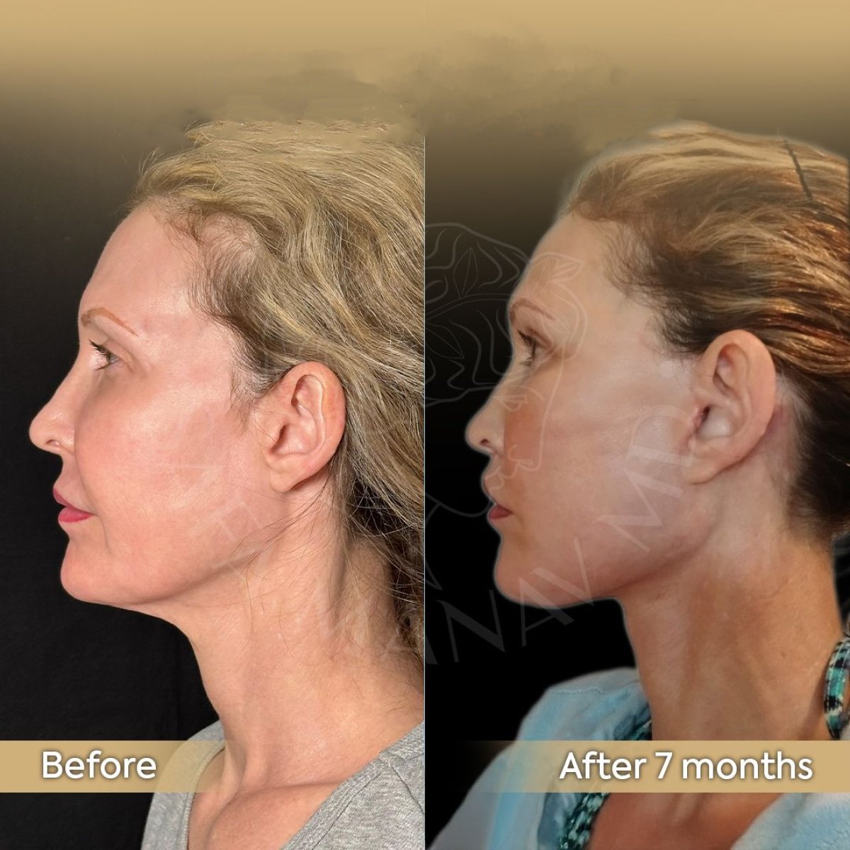 Facelift before and after 7 months at Dr. Safa Manav Clinic, visible facial rejuvenation result