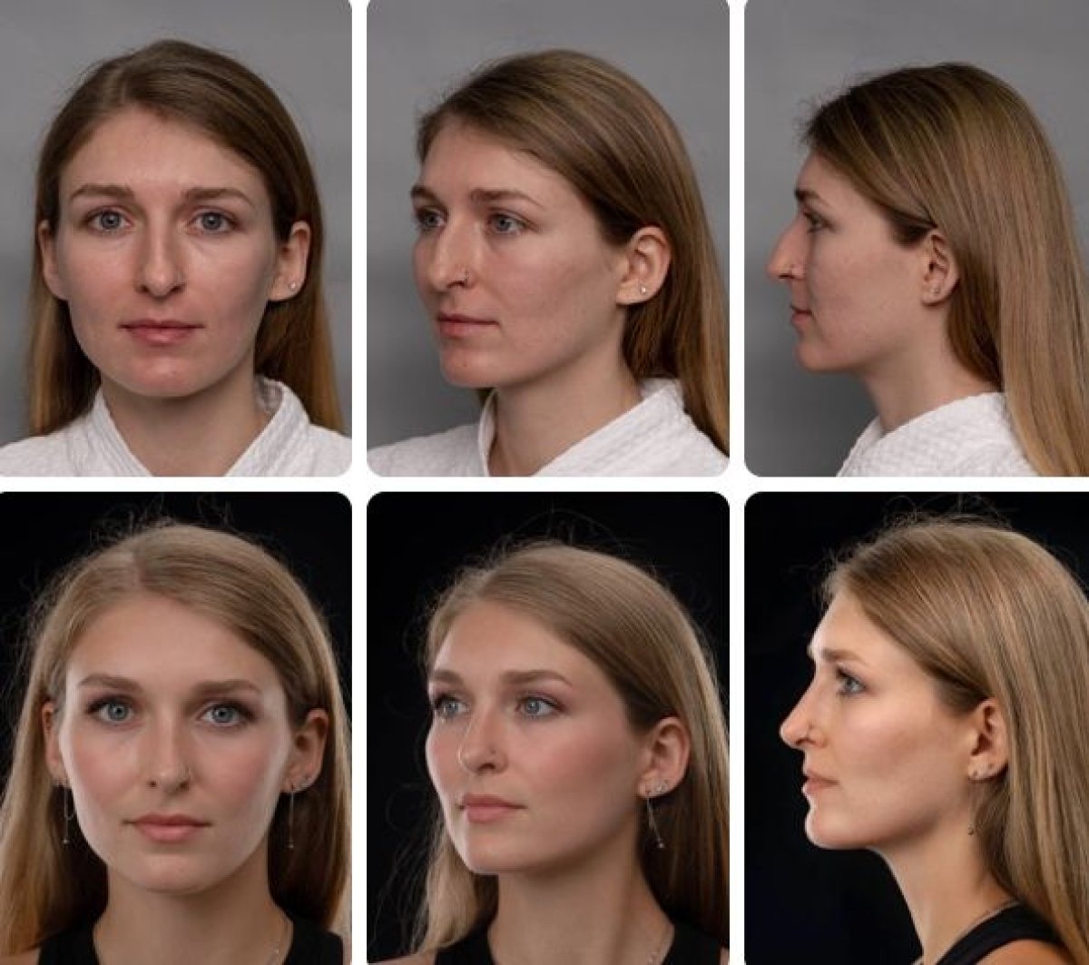 نتائج تجميل الأنف قبل وبعد في Yurchenko Plastic Surgery Team، إعادة تشكيل الأنف