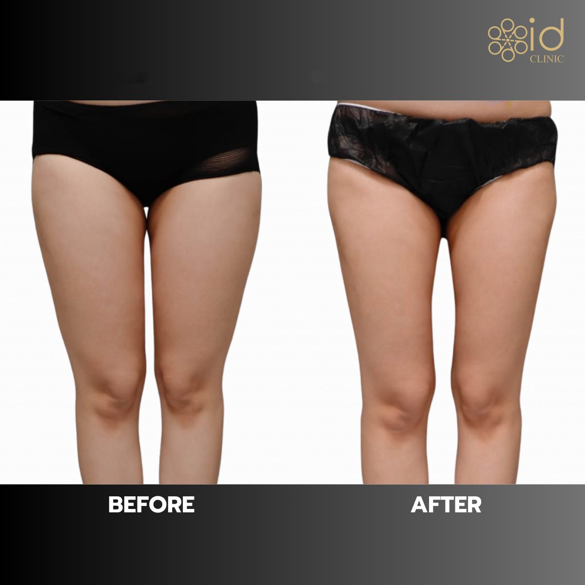 Before and after thigh liposuction results at ID Clinic Bangkok, slimmer leg contour visible