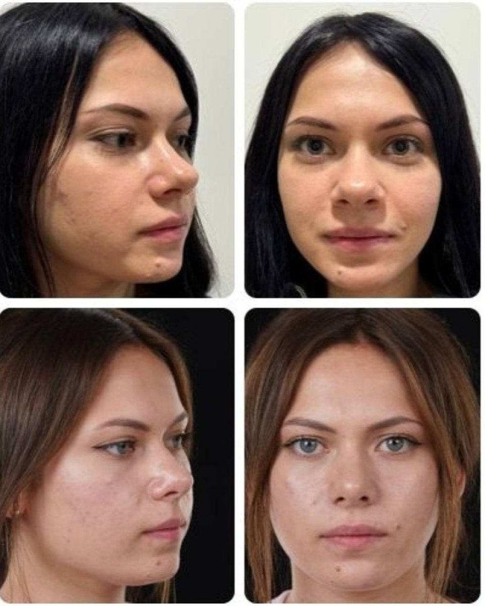 نتائج عملية تجميل الأنف قبل وبعد في Yurchenko Plastic Surgery Team، إعادة تشكيل الأنف
