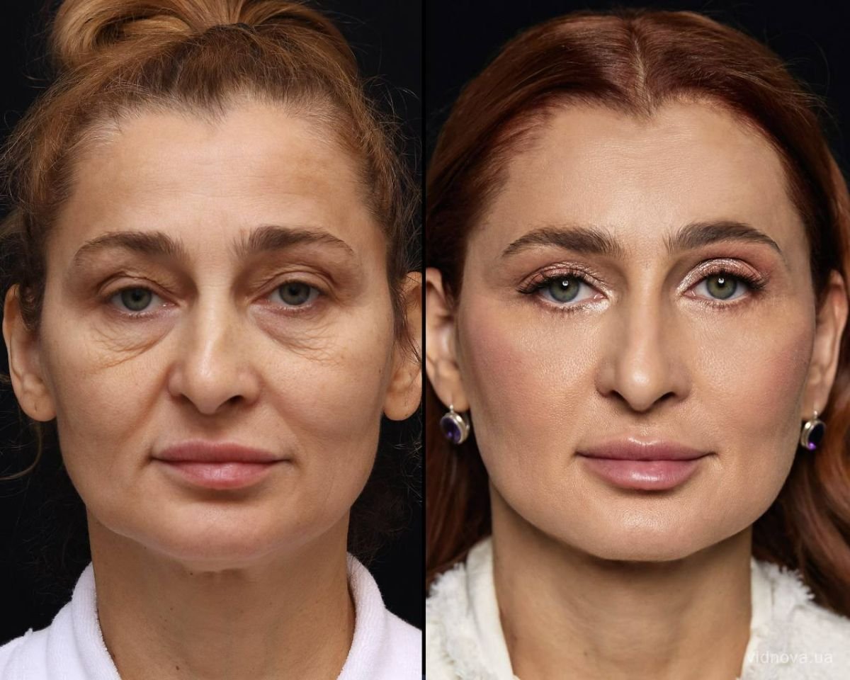 Resultados de lipofilling facial antes y después en Vidnova Clinic – rejuvenecimiento y volumen