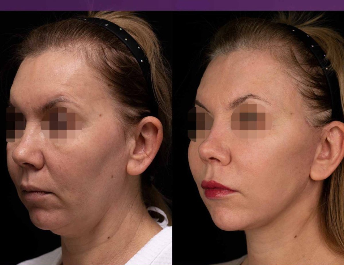 Vorher-nachher-Ergebnis Lipofilling im Gesicht bei Vidnova Clinic – Konturverbesserung sichtbar