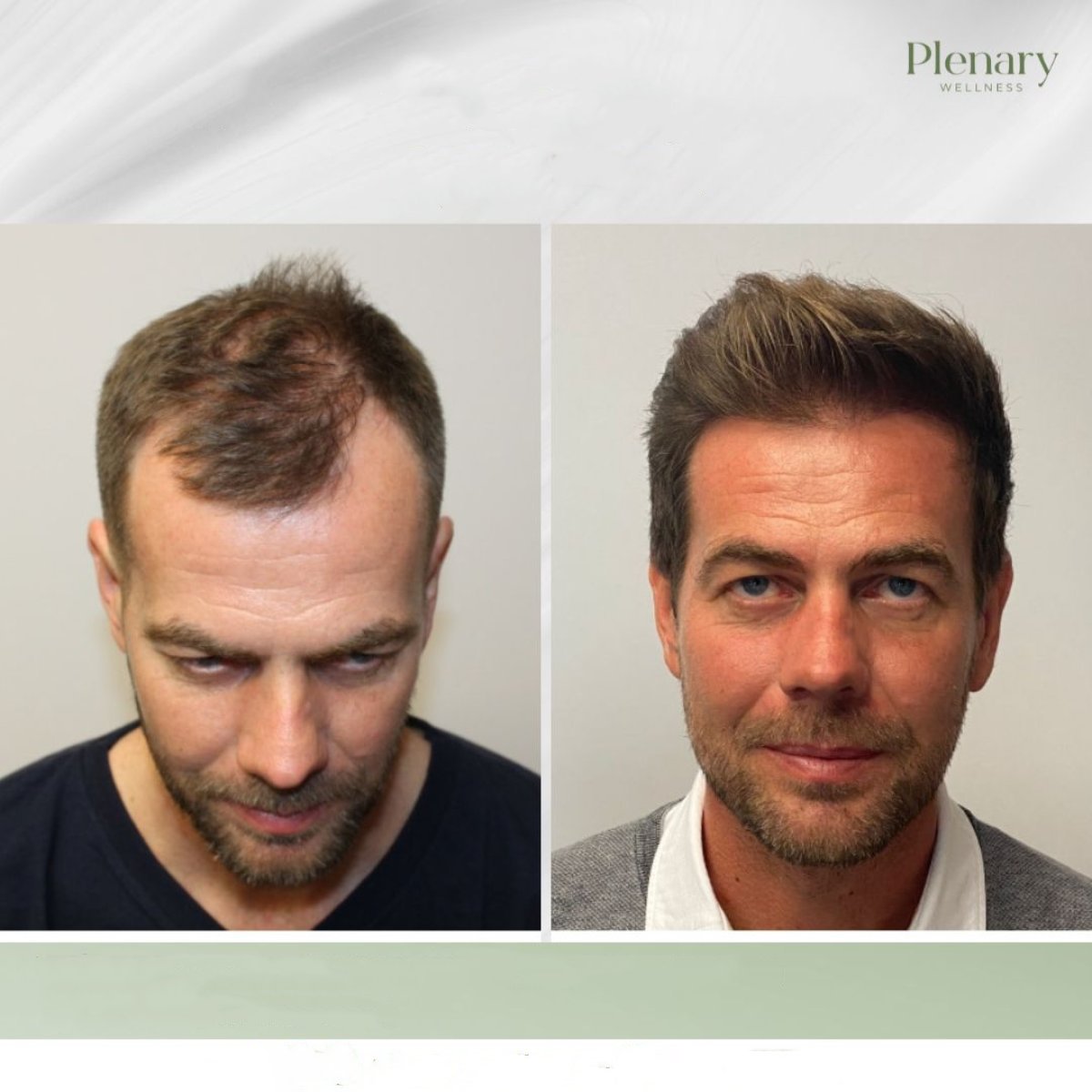 Before and after hair transplant results at Plenary Wellness, restored hairline and density
