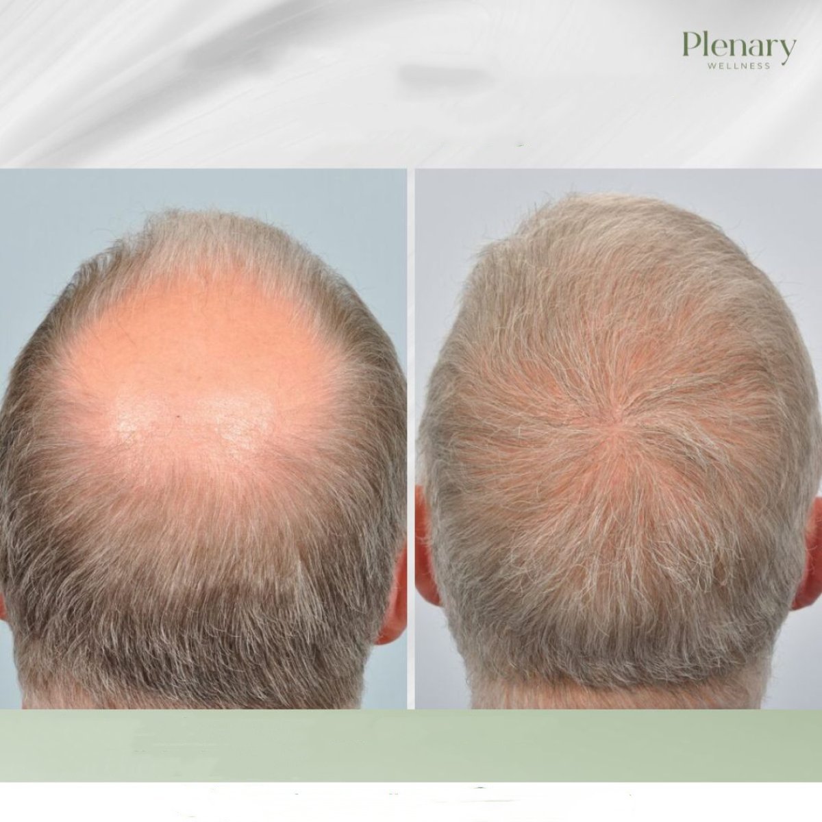Vorher-nachher-Ergebnis der Haartransplantation bei Plenary Wellness, mehr Haardichte am Wirbel