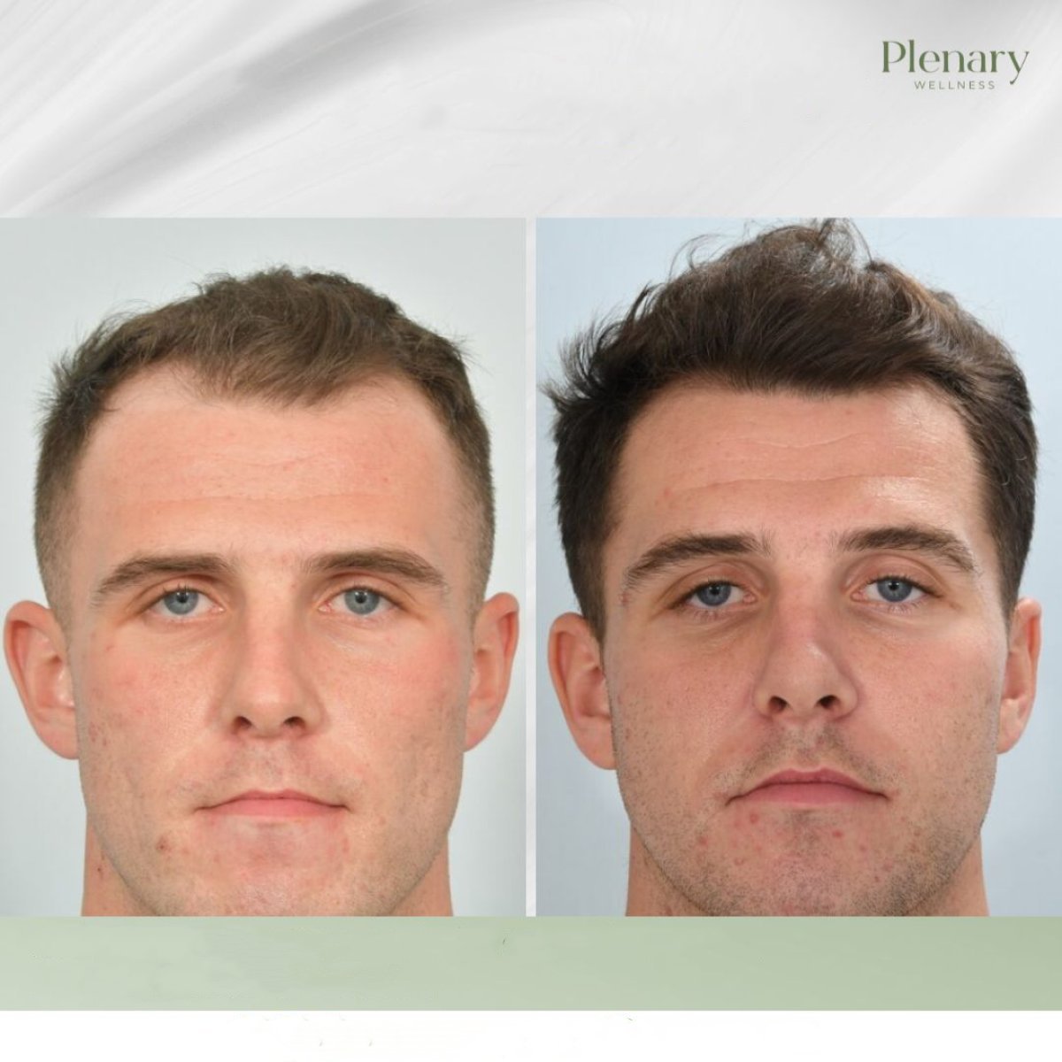 نتائج زراعة الشعر قبل وبعد في Plenary Wellness، كثافة شعر محسنة لدى رجل