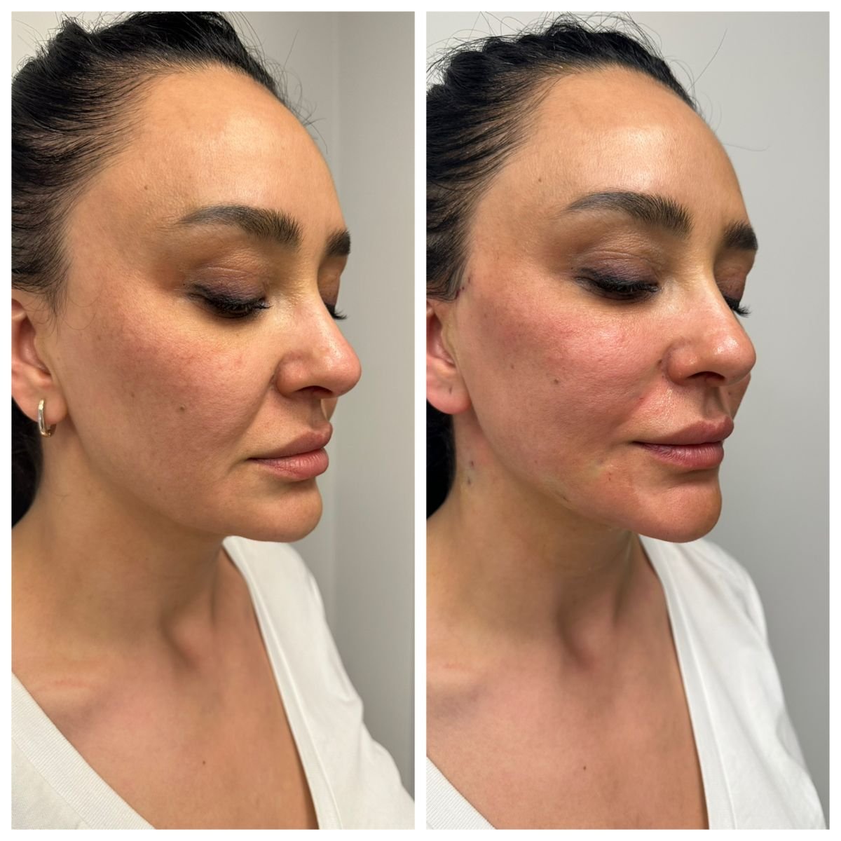 Before and after threads lifting result at CE International Hospital, facial contour improvement