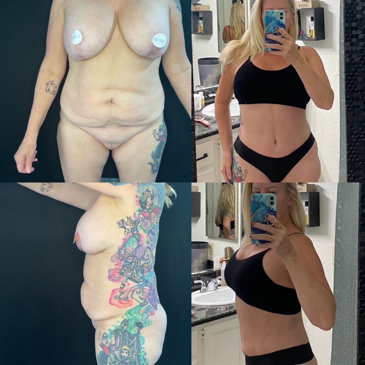 Resultados de abdominoplastia y liposucción antes y después en Marroquín & Sandoval