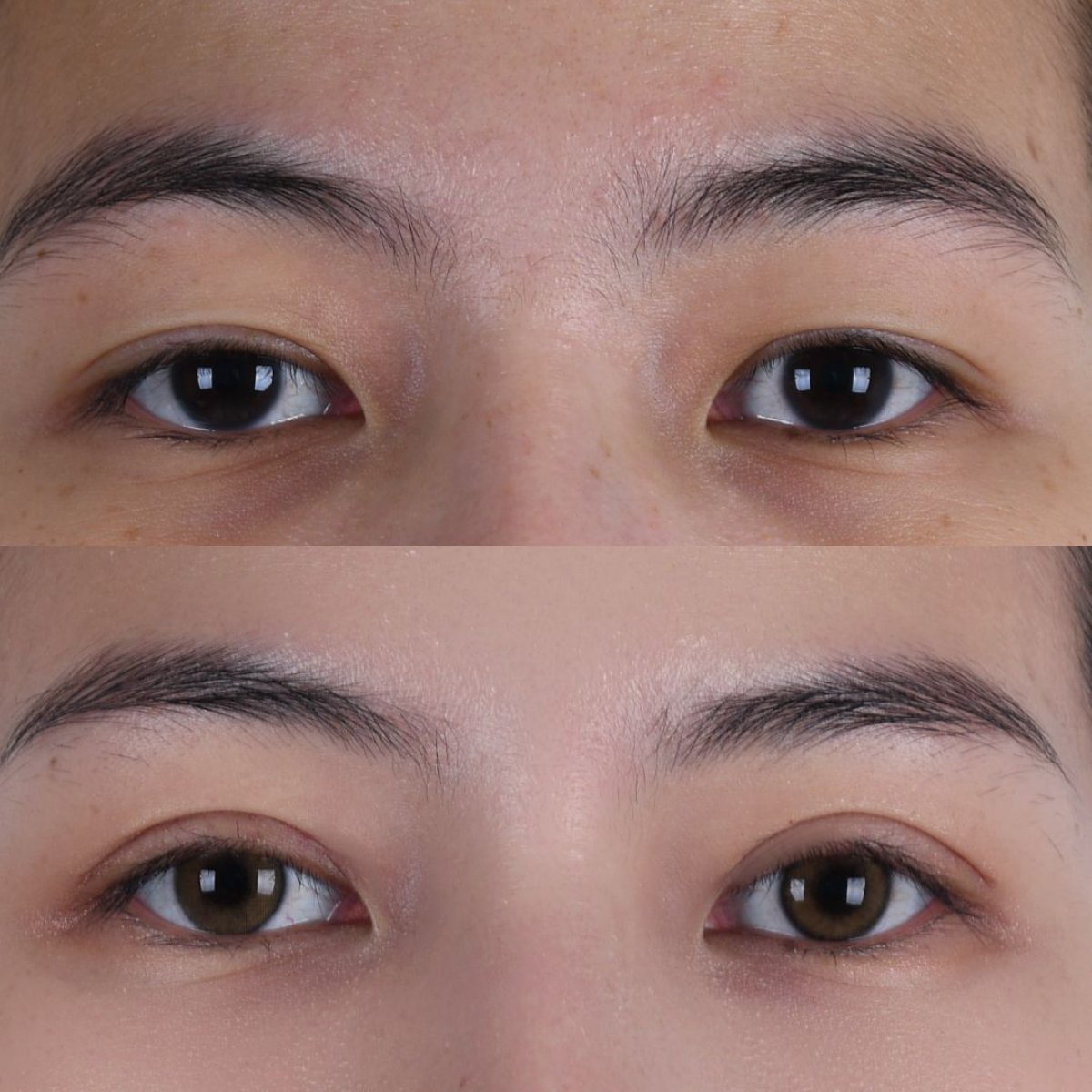Resultados de blefaroplastia antes y después – corrección de párpados natural