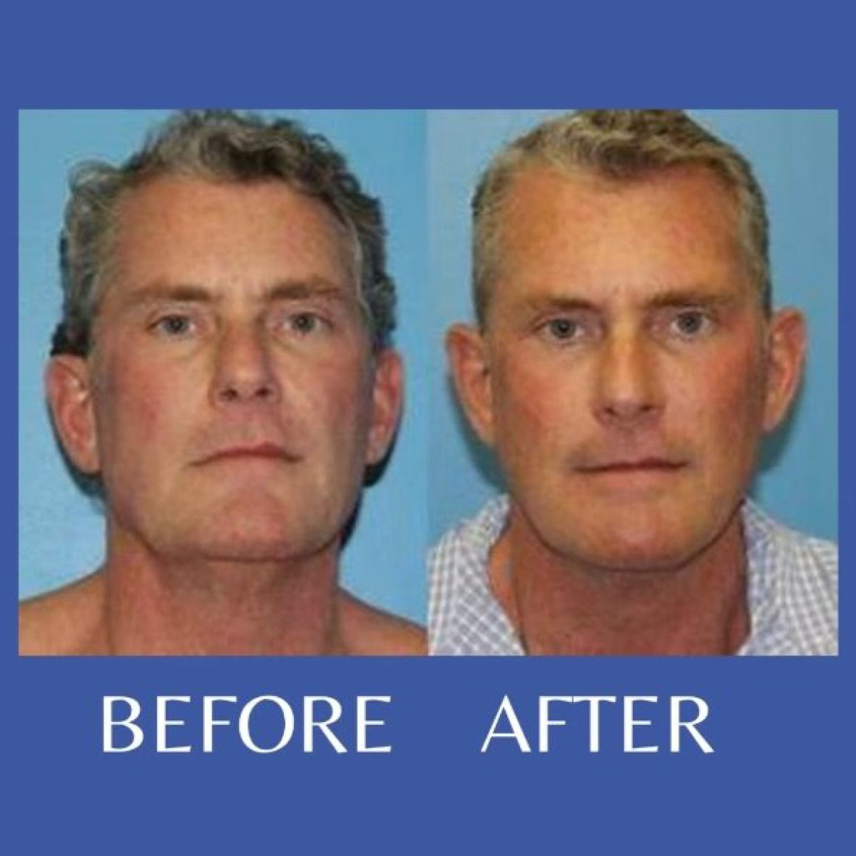 Before and after mini facelift results at ID Clinic Bangkok, visible facial rejuvenation
