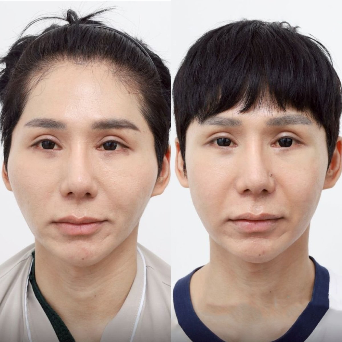 Before and after cheekbone reduction at Wansiri Hospital, visible facial contouring result