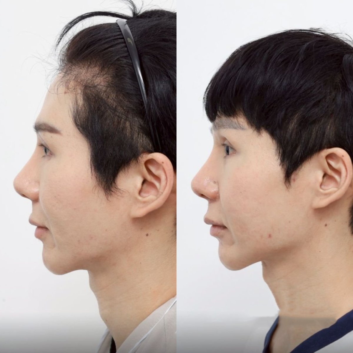 Antes y después de reducción de pómulos en Wansiri Hospital, mejora visible del contorno facial
