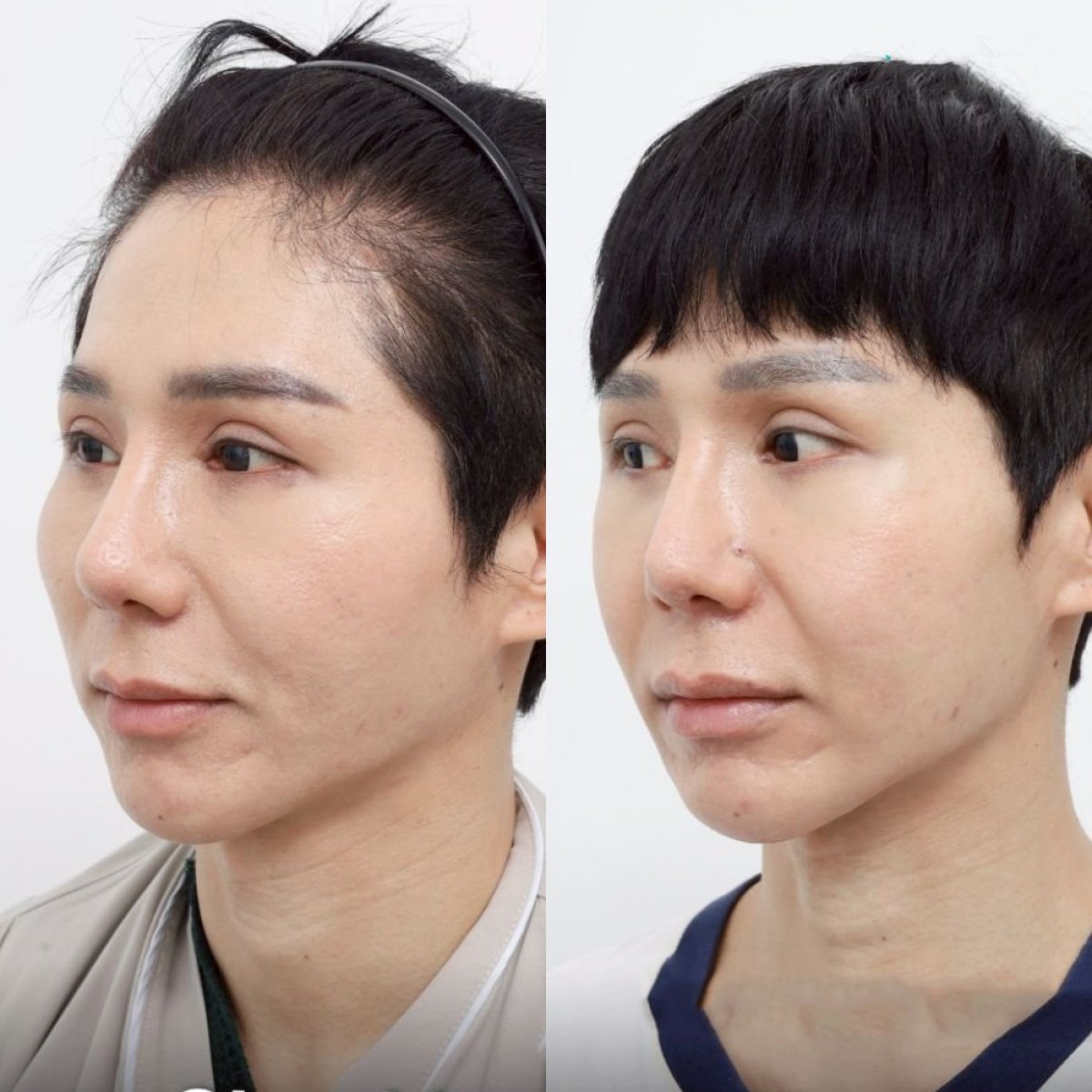 Antes y después de reducción de pómulos en Wansiri Hospital, mejora visible del contorno facial