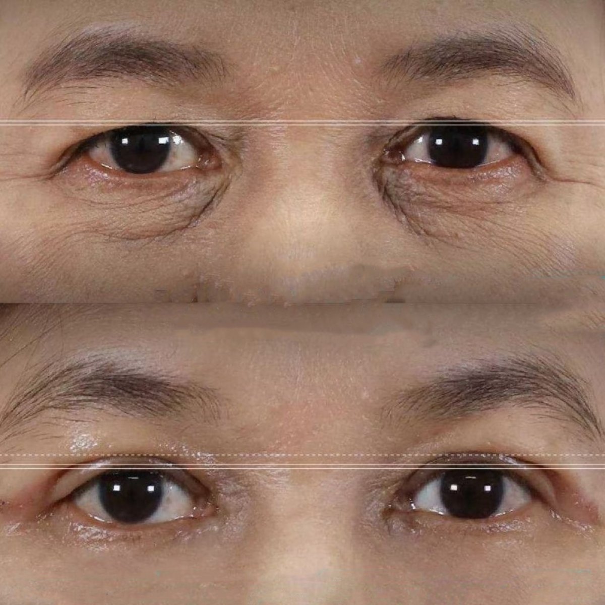 Resultados de blefaroplastia superior antes y después en Wansiri Hospital, mejora de párpados