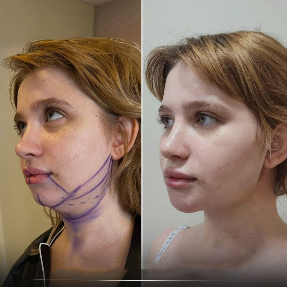 Before and after threads lifting result at CE International Hospital, improved jawline contour