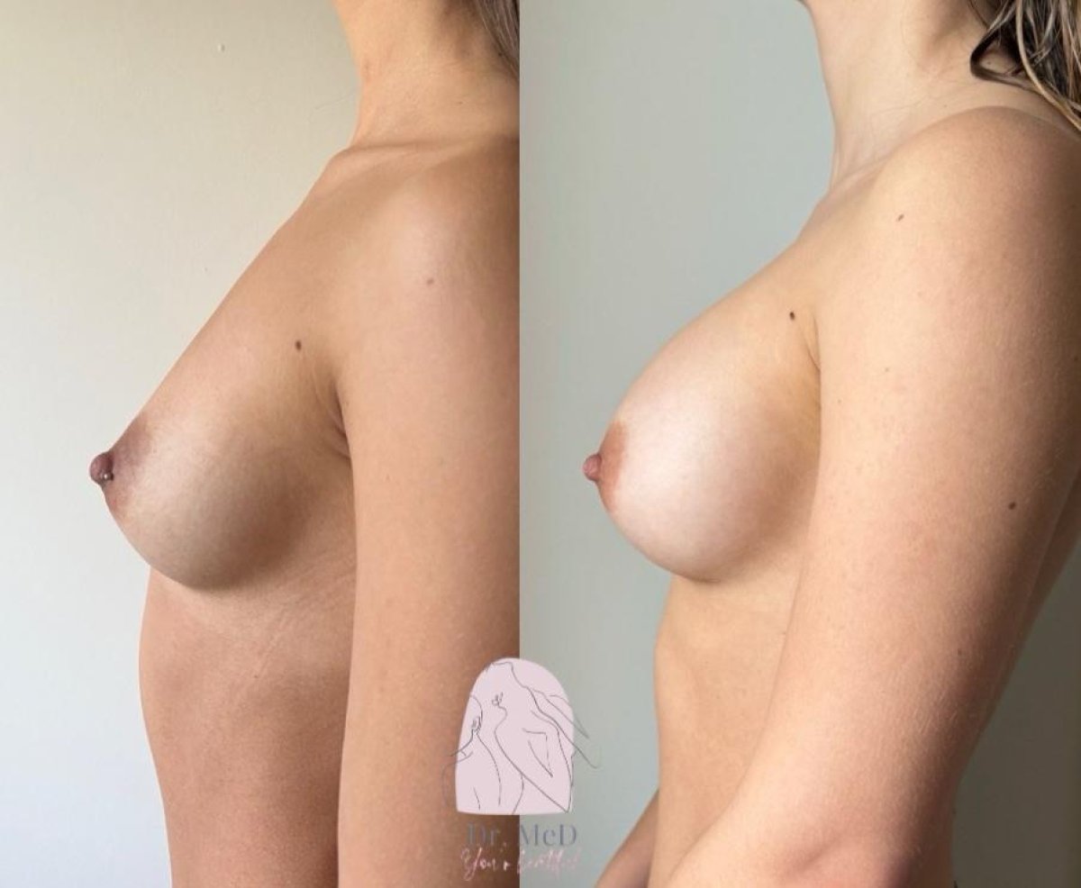 Resultados de mamoplastia antes y después en Dr. MED – mejora de forma y elevación mamaria