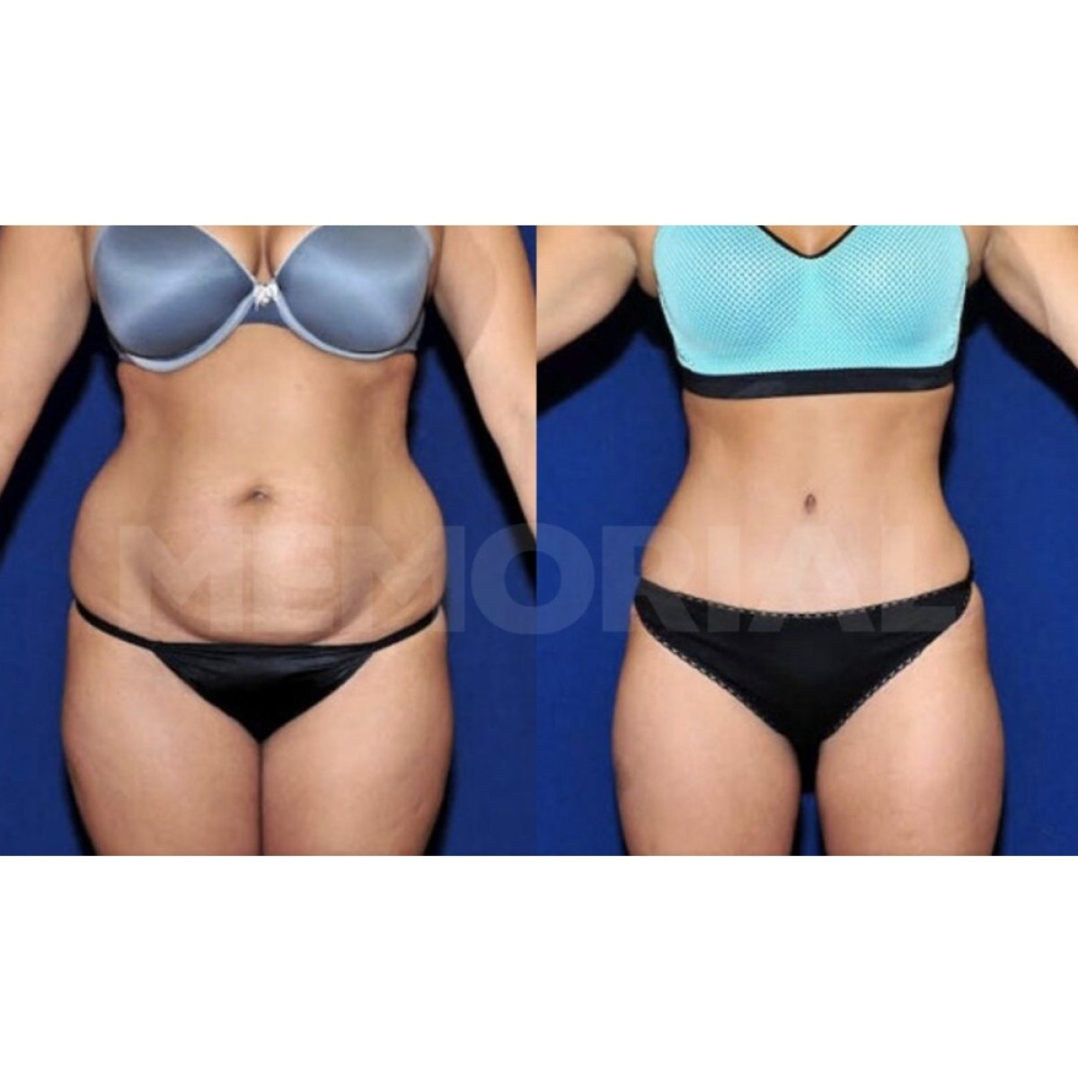 Before and after tummy tuck results at Memorial Bahçelievler Hospital, improved abdomen contour