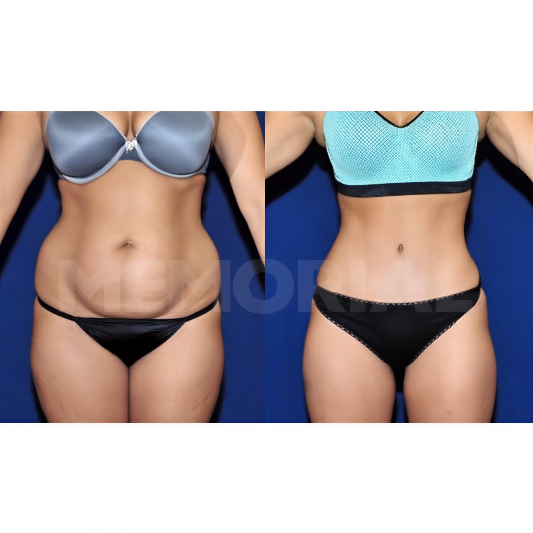 Resultados de abdominoplastia y liposucción antes y después en Memorial Bahçelievler Hospital