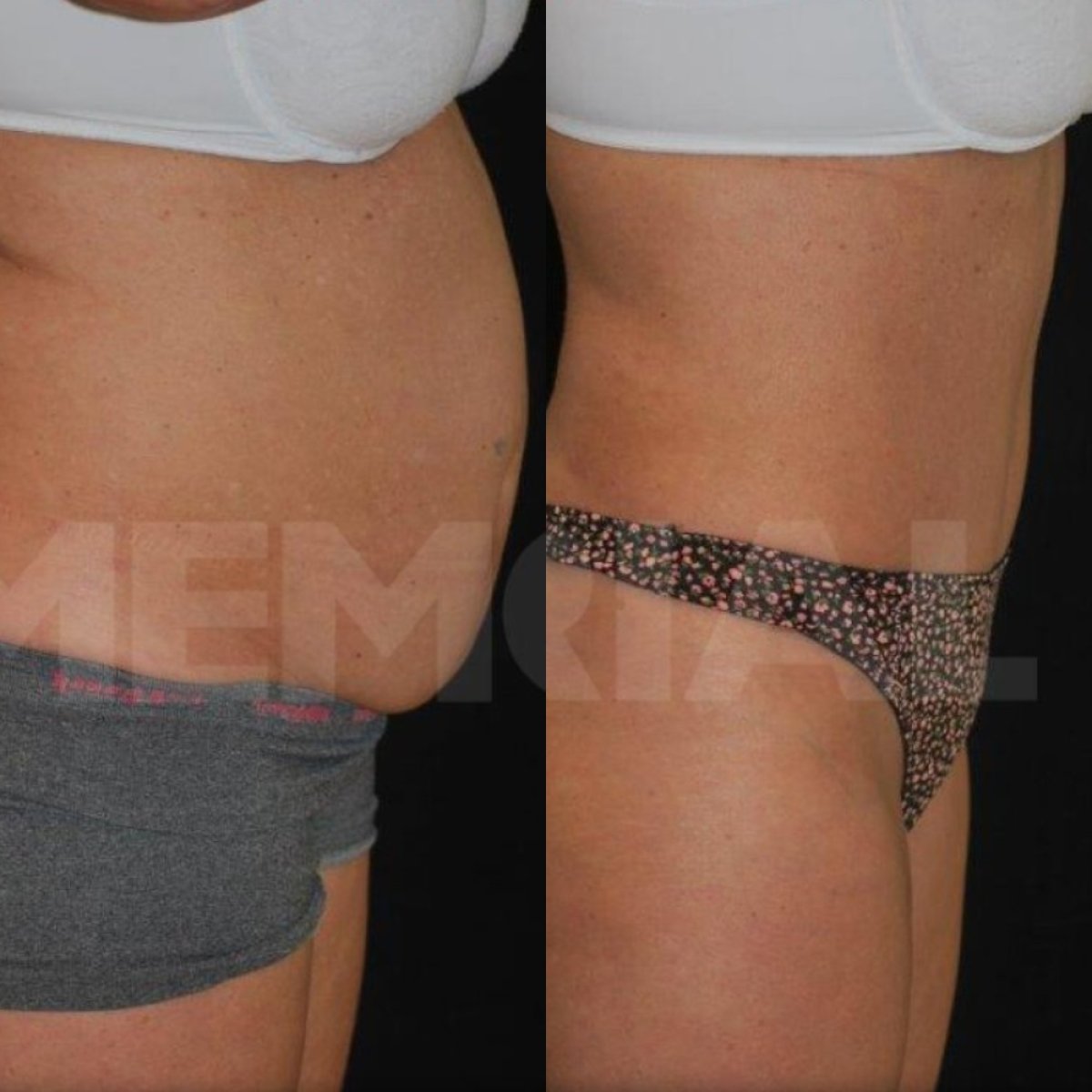 Before and after tummy tuck and liposuction results at Memorial Bahçelievler Hospital