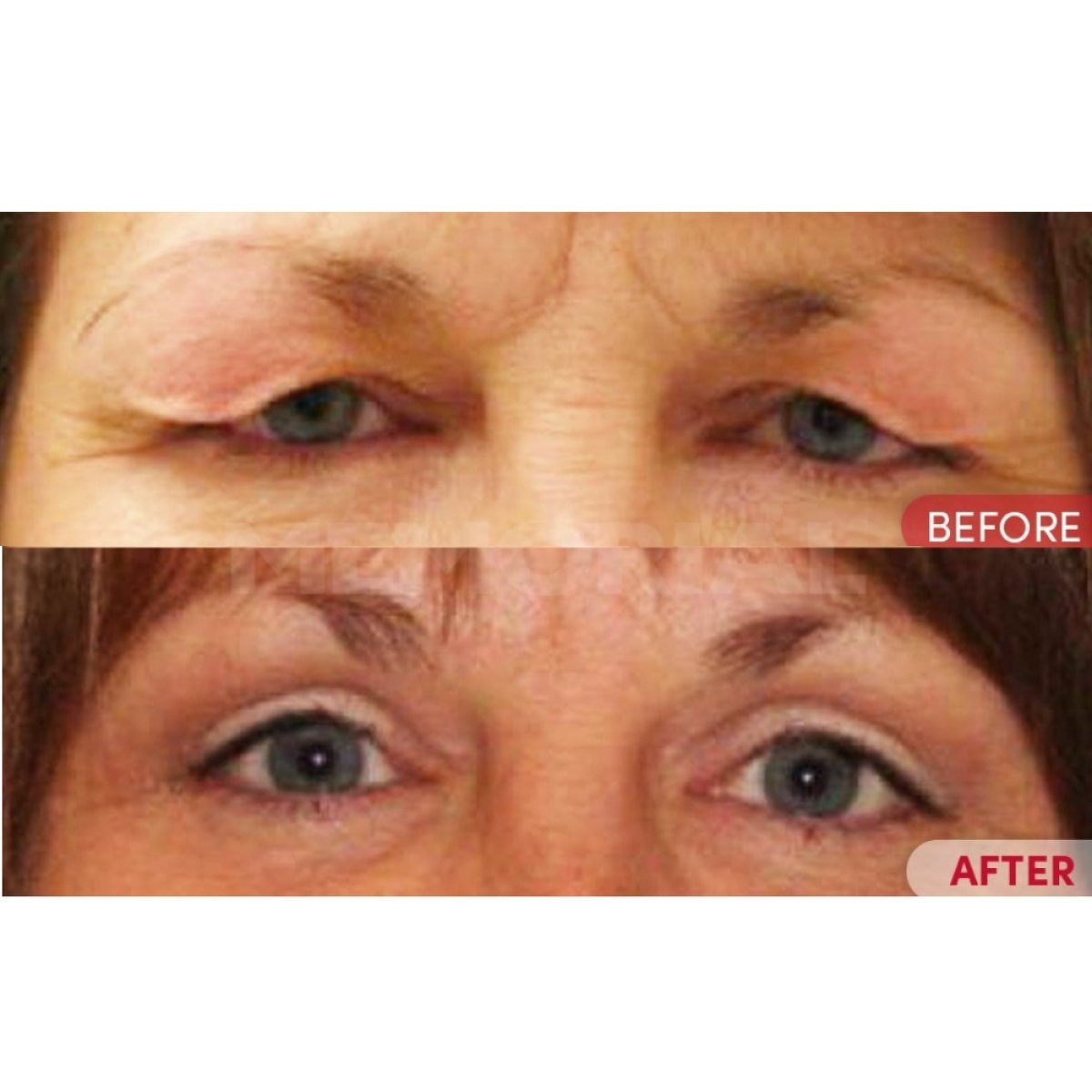 Resultados de blefaroplastia antes y después en Memorial Bahçelievler Hospital, corrección de párpados