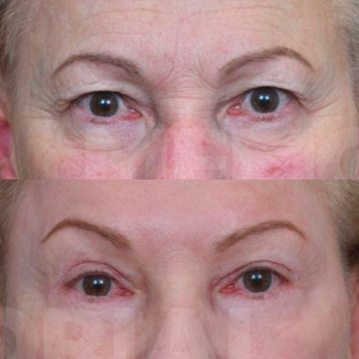 Resultados de blefaroplastia antes y después en Memorial Bahçelievler Hospital, corrección de párpados