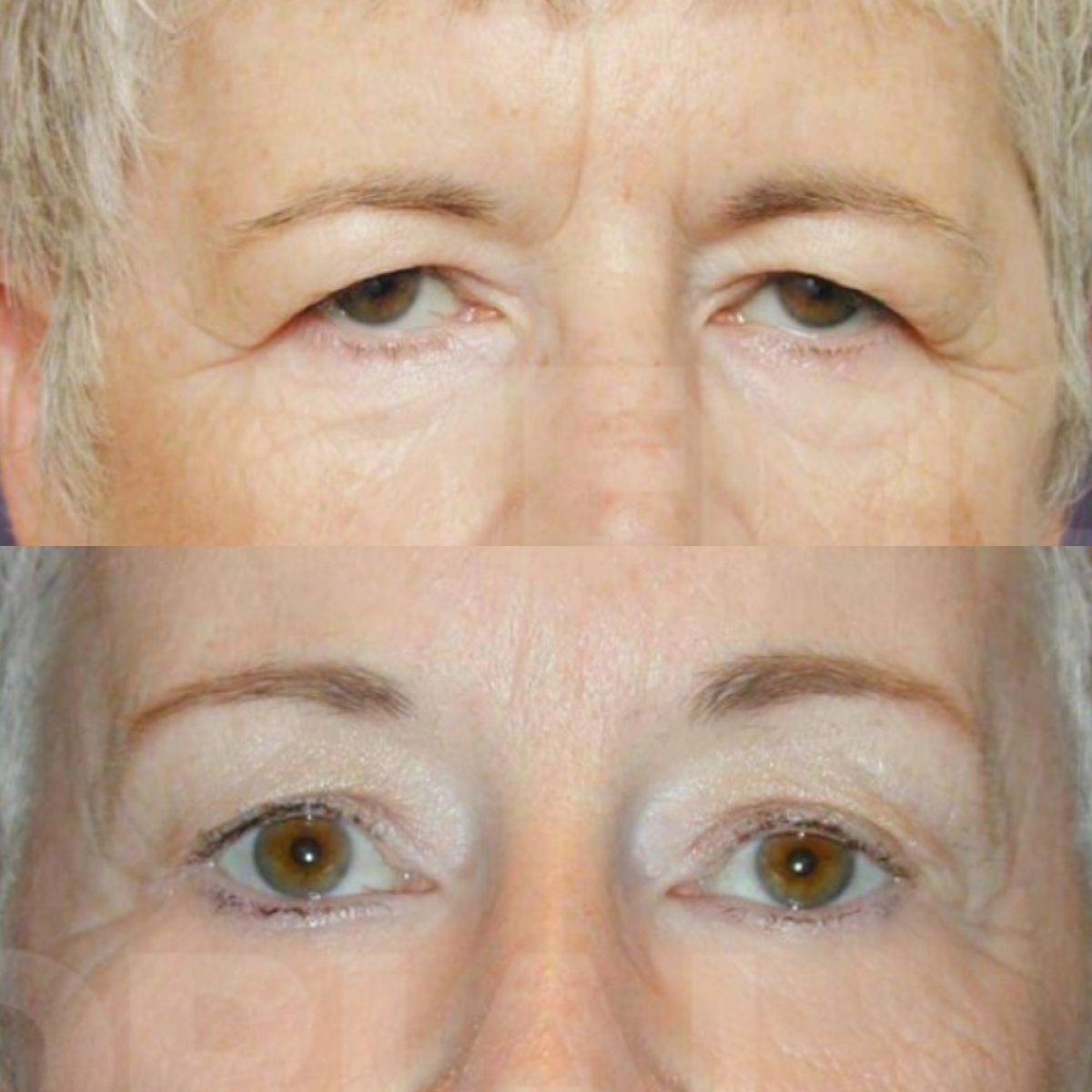 Resultados de blefaroplastia antes y después en Memorial Bahçelievler Hospital, corrección de párpados