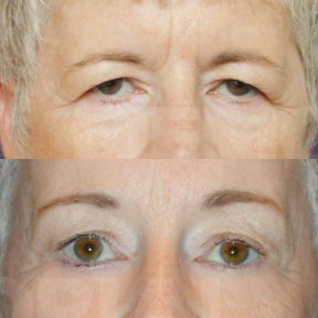 Blepharoplasty for Refreshed & Youthful Eyes — 5★ Hotel, 5 Nights