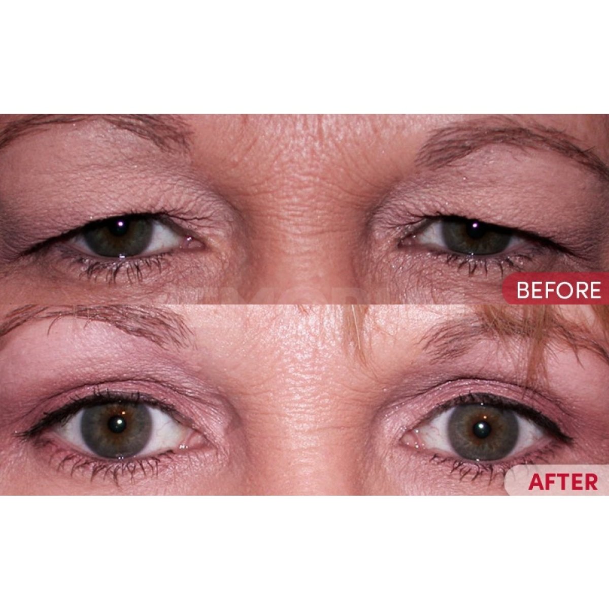 Résultats avant-après de blépharoplastie à Memorial Antalya Hospital, correction des paupières