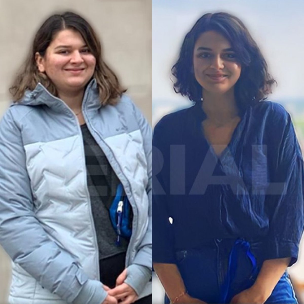 Before and after gastric sleeve surgery at Memorial Ataşehir Hospital, visible weight loss result