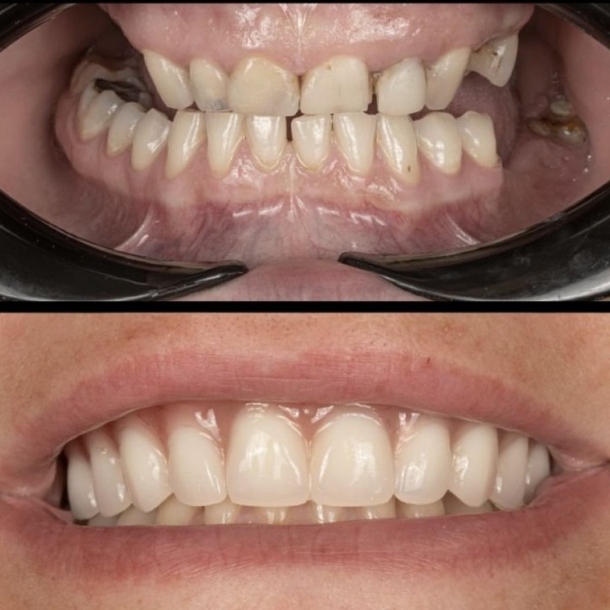 Resultado antes y después de implantes All-on-6 en HALDENT Dental Clinic, restauración de sonrisa