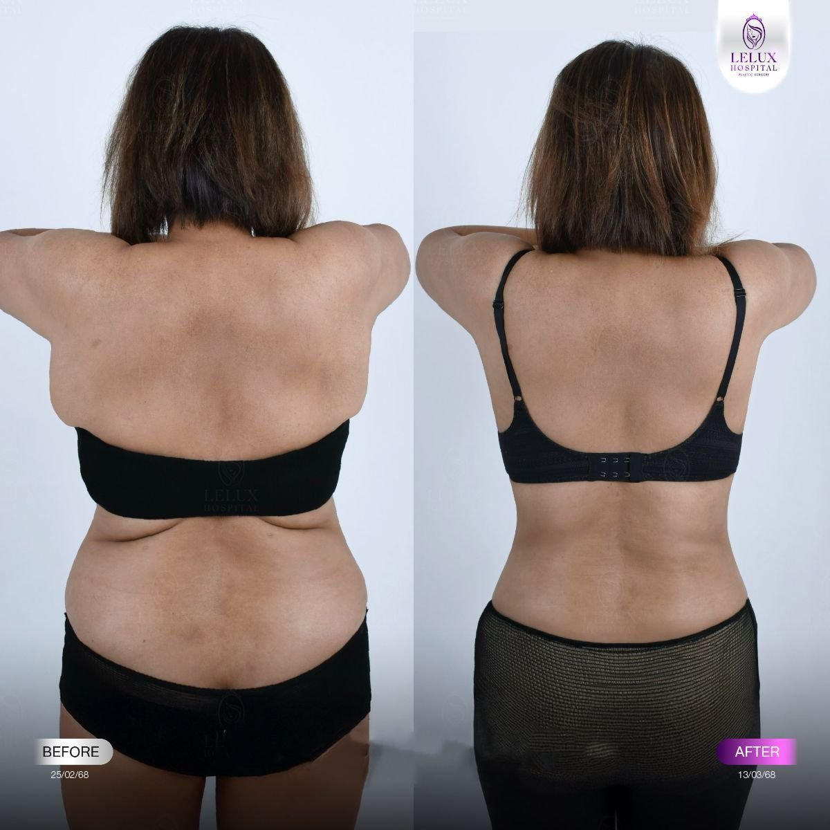 Résultats avant et après Vaser liposuccion à Lelux Hospital – contour du dos amélioré